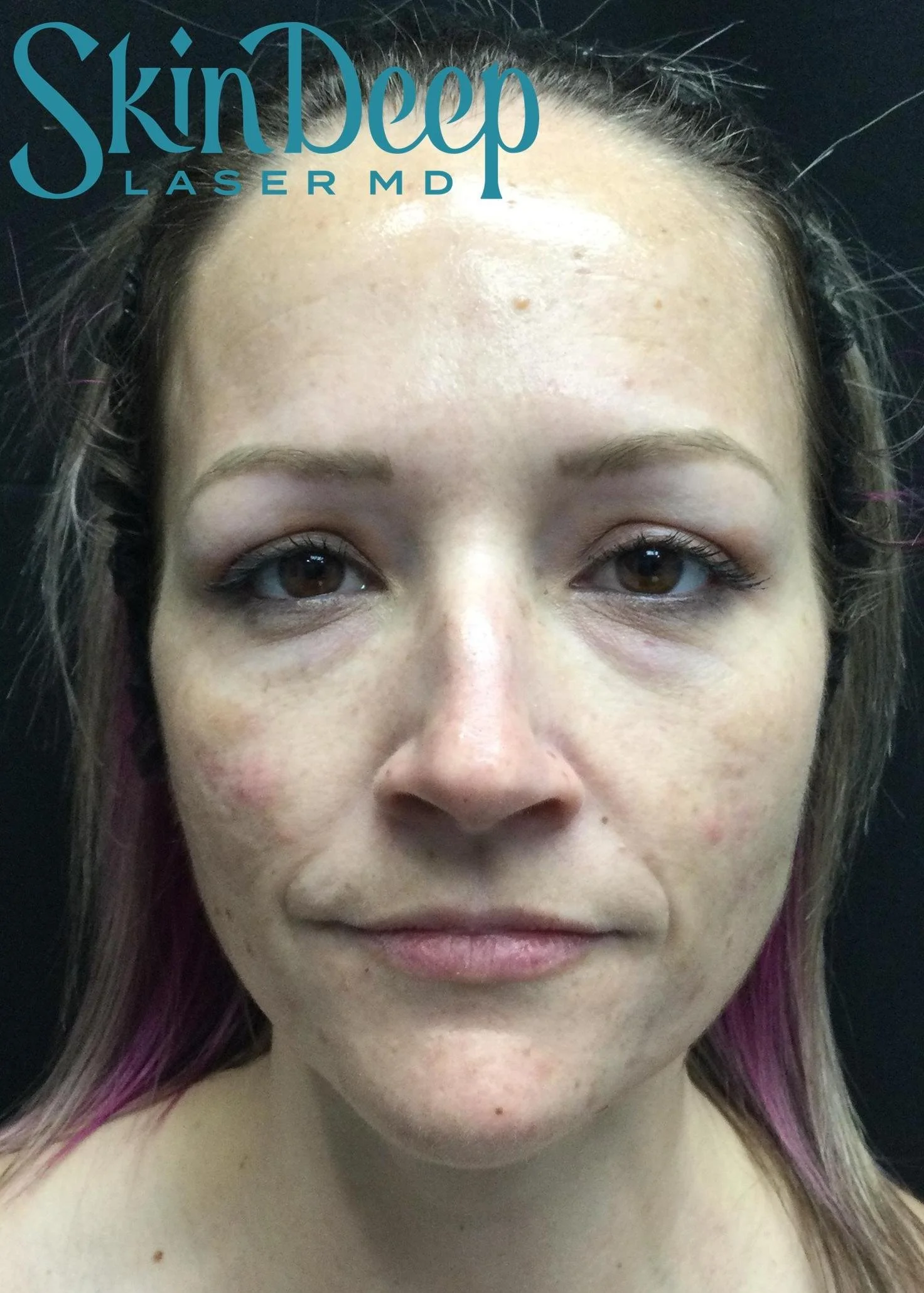 PT 029 Peel Pgm Before.jpg