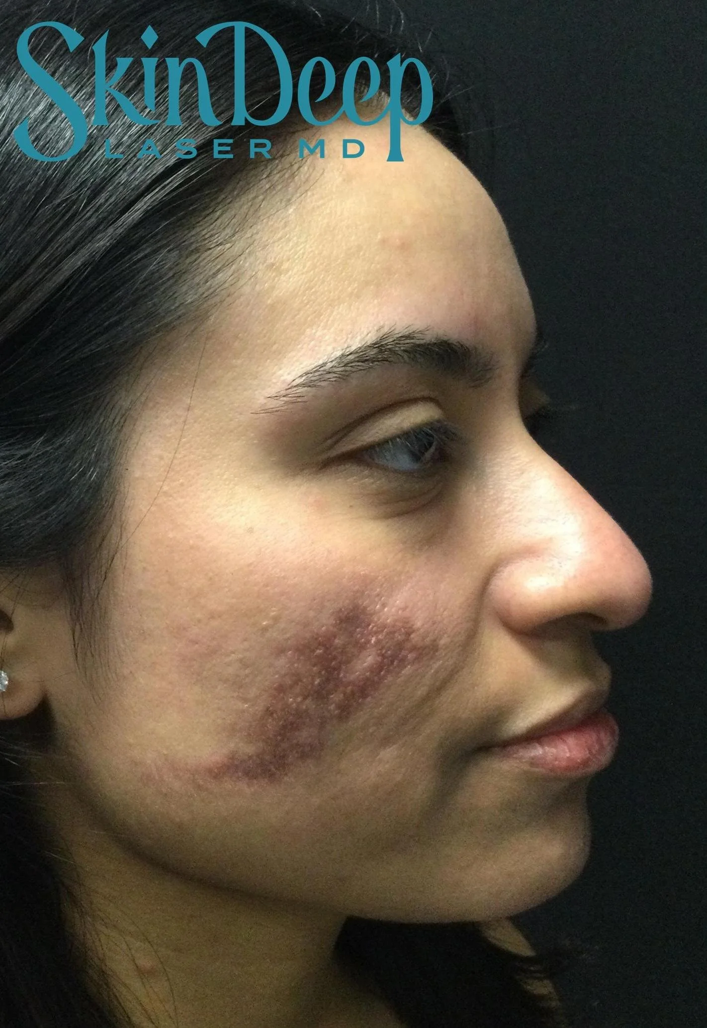 PT 030 Pico Scars Before.jpg