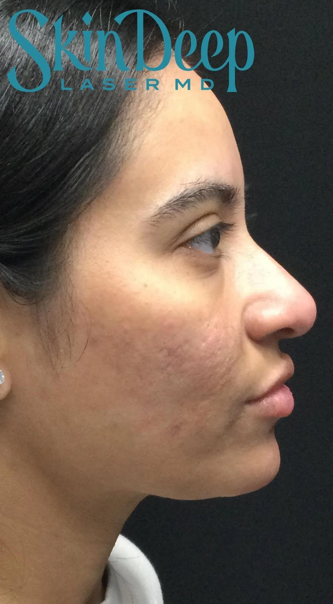 PT 030 Pico Scars Post.jpg