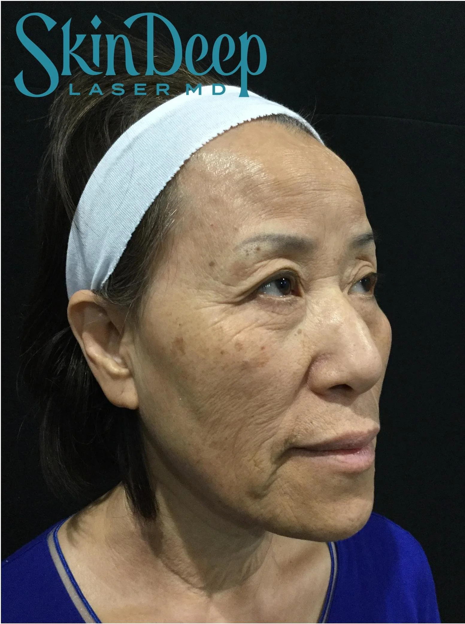 PT 033 Pico Pigment Before.jpg