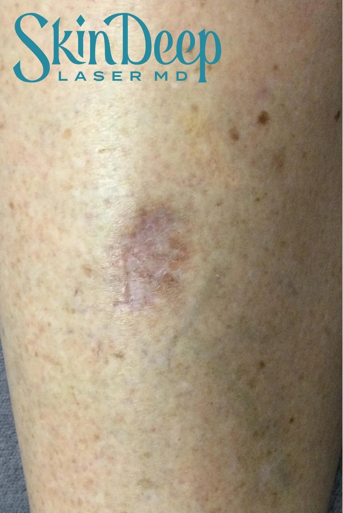 PT 035 IPL Red Scar Before.jpg
