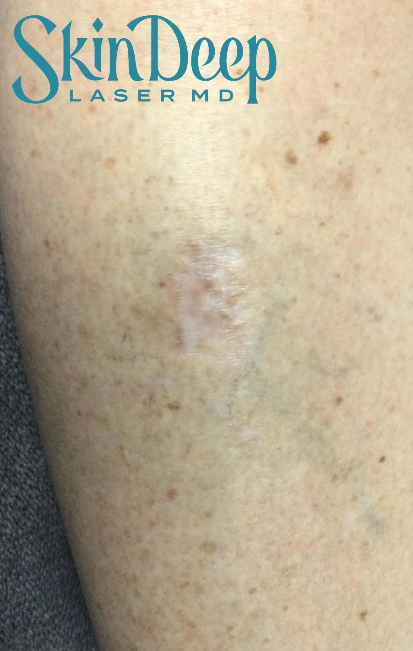 PT 035 IPL Red Scar Post 2 Tx.jpg