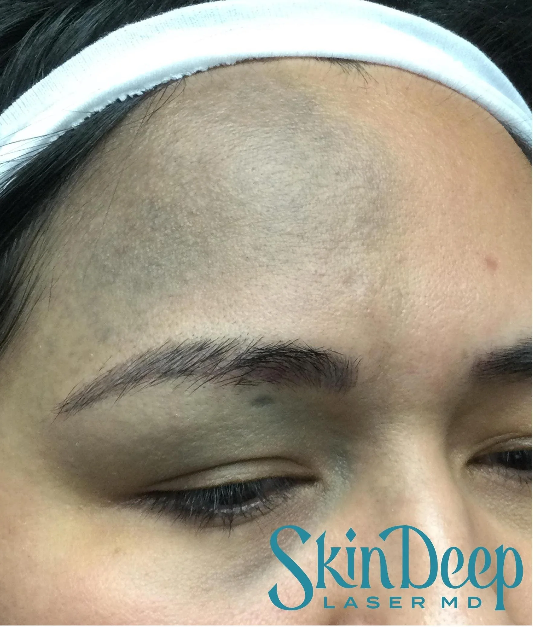 PT 039 Pico Nevus of Ota Before.jpg