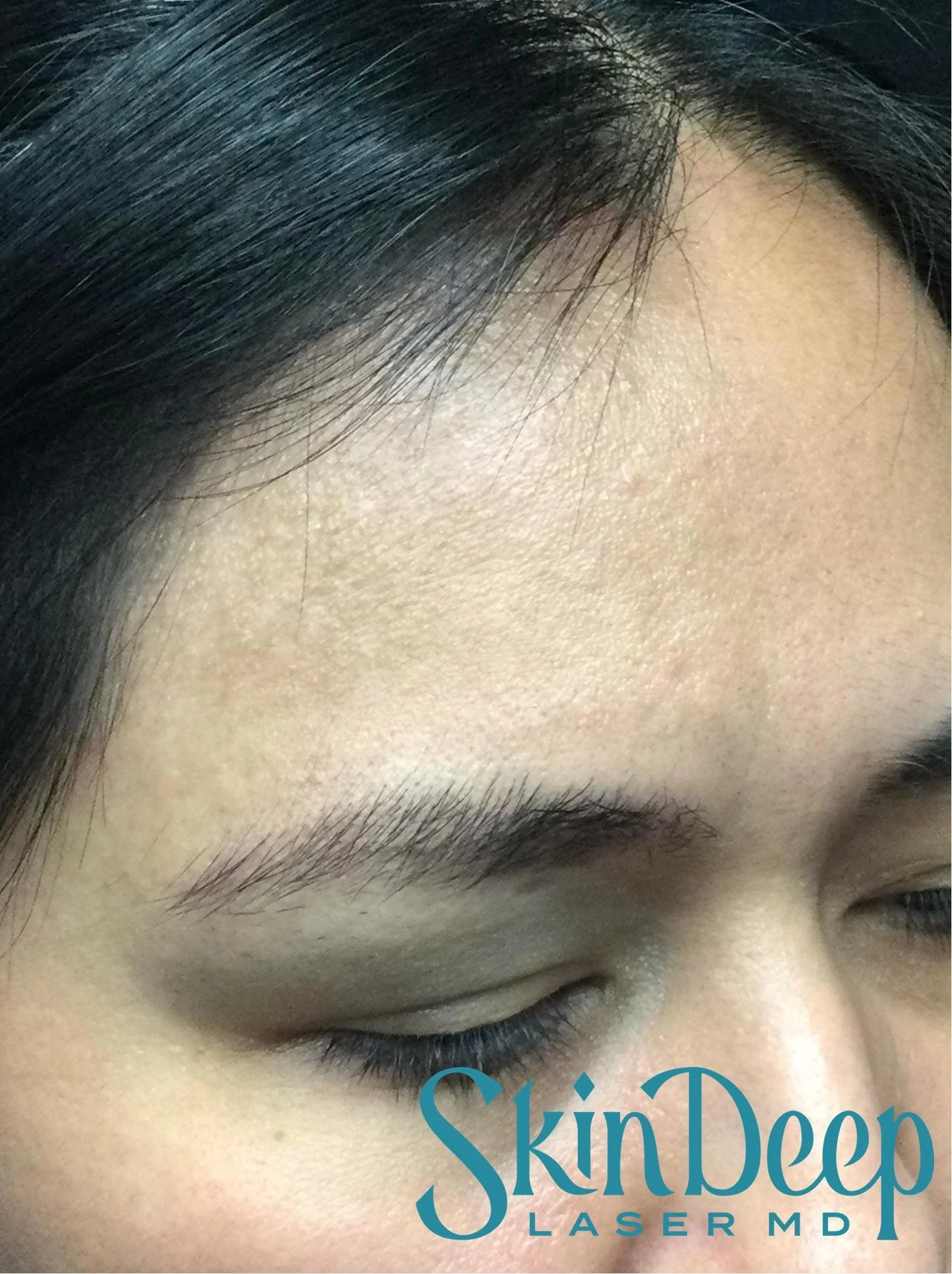 PT 039 Pico Nevus of Ota Post 8 Tx.jpg
