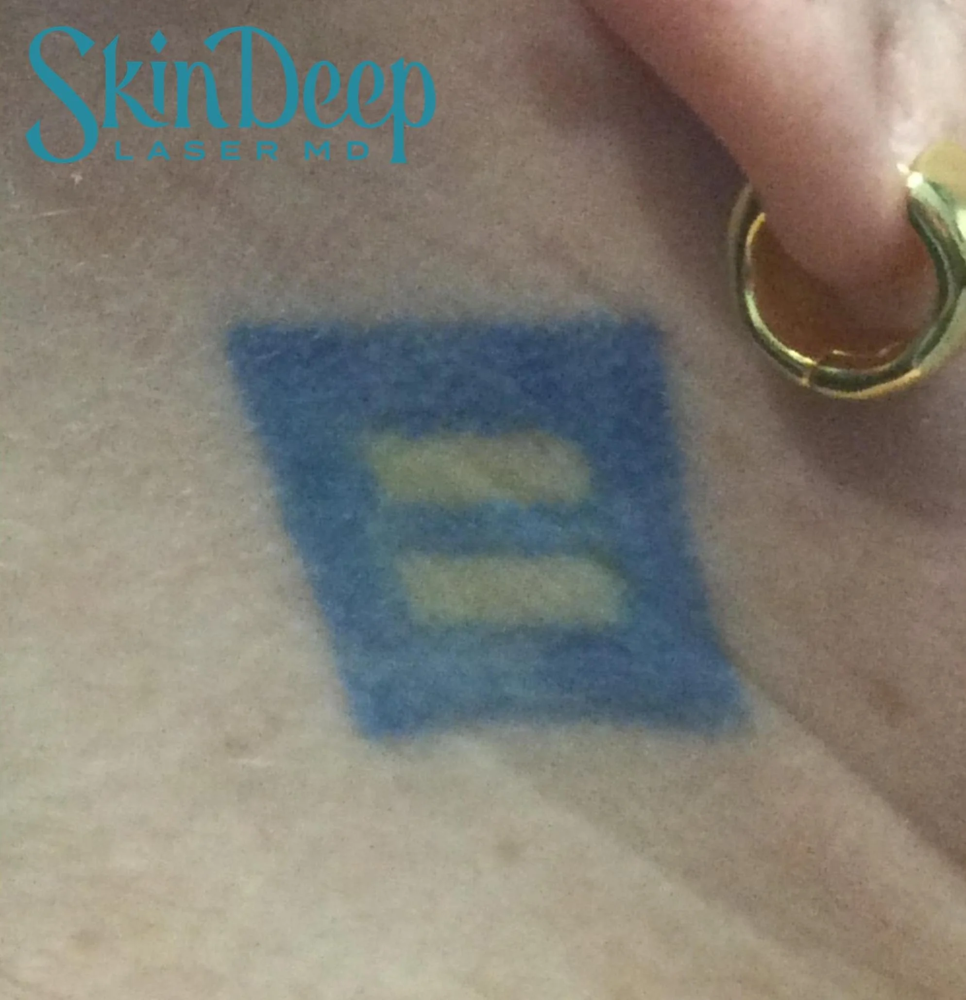 PT 041 Tattoo Before.jpg