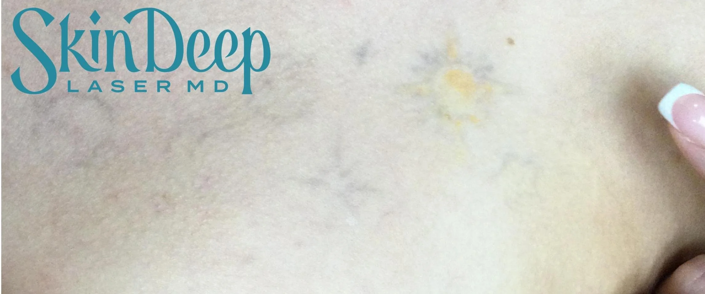PT 042 Tattoo Post 8 Tx.jpg