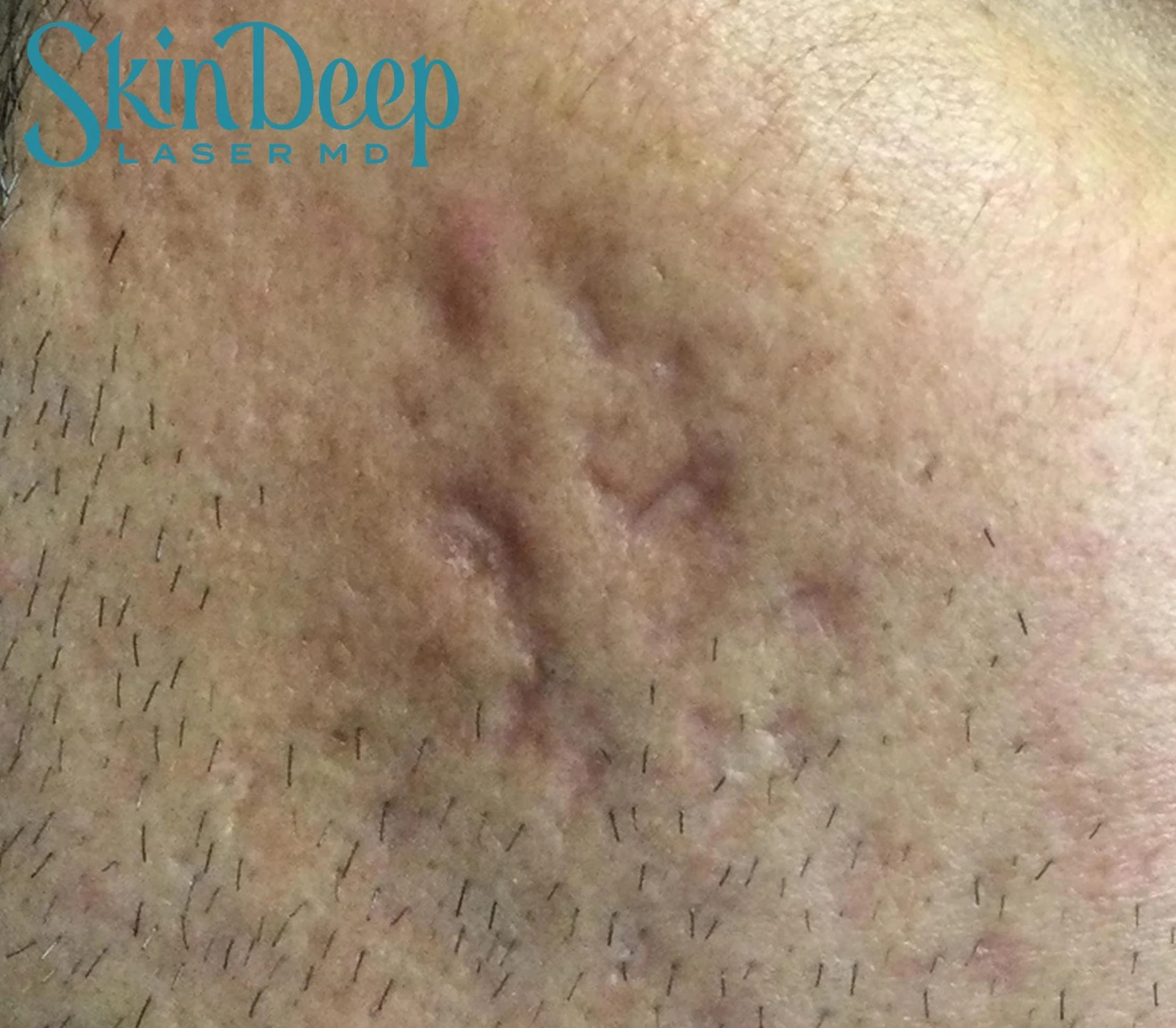 PT 047 1540 Acne Scars Before.jpg