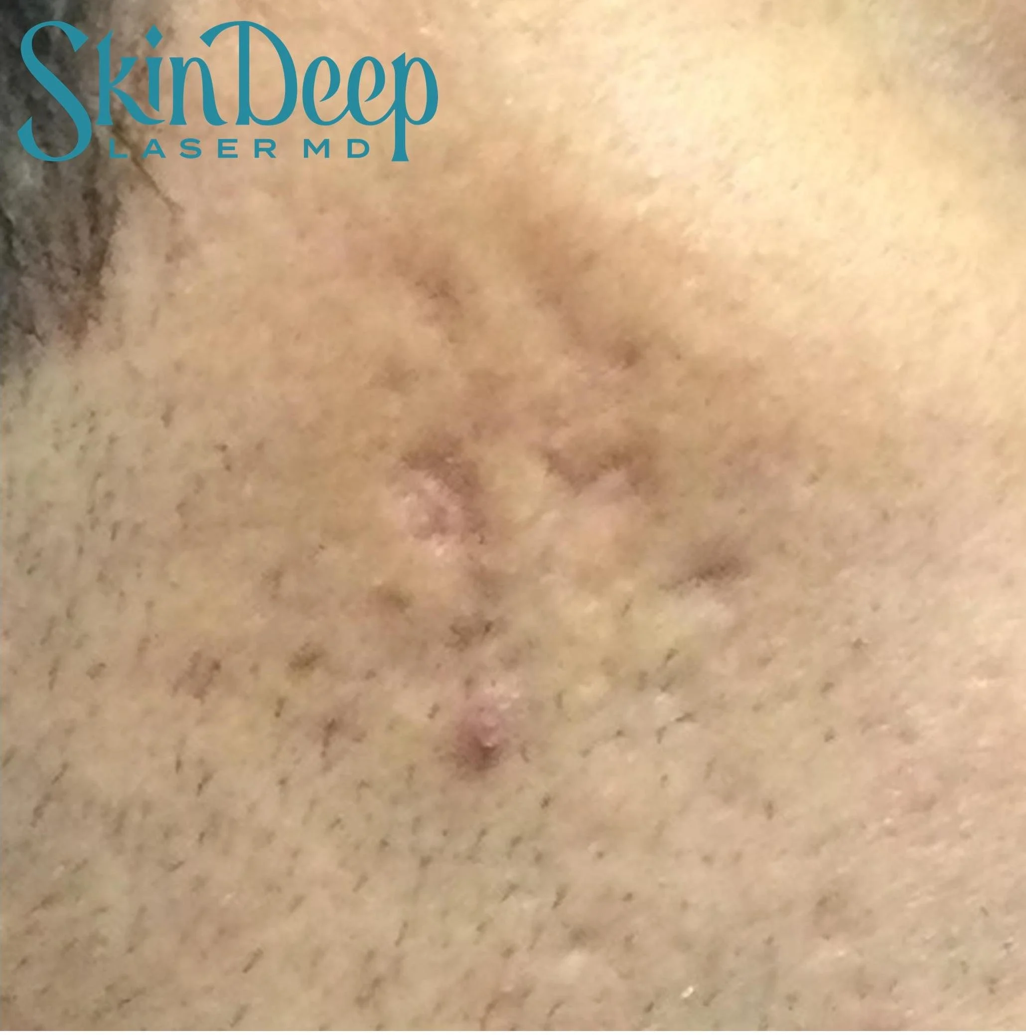 PT 047 1540 Acne Scars Post 2 Tx.jpg