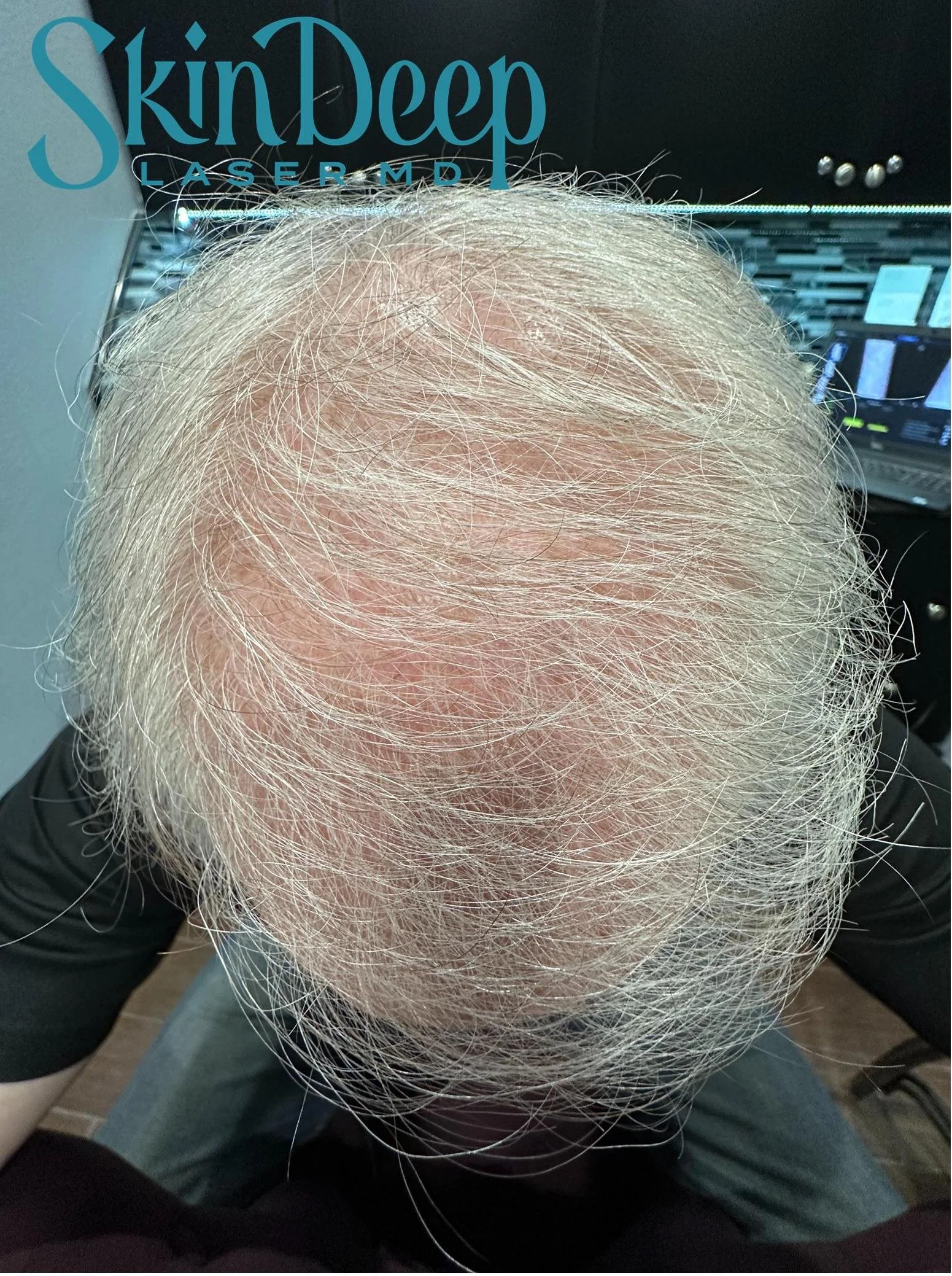 PT 048 Hair Restor Before.jpg