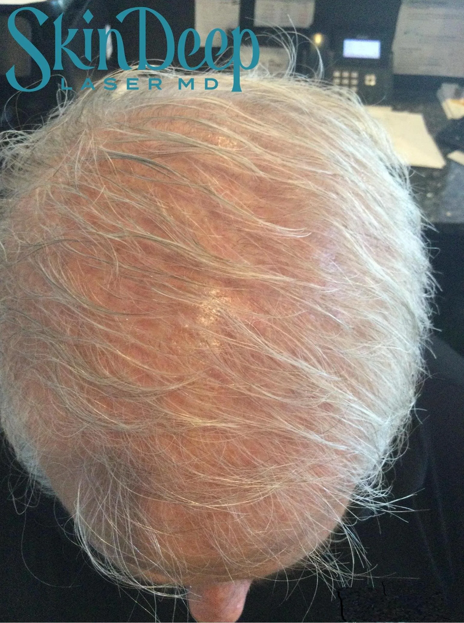 PT 048 Hair Restor Post 1 Tx.jpg
