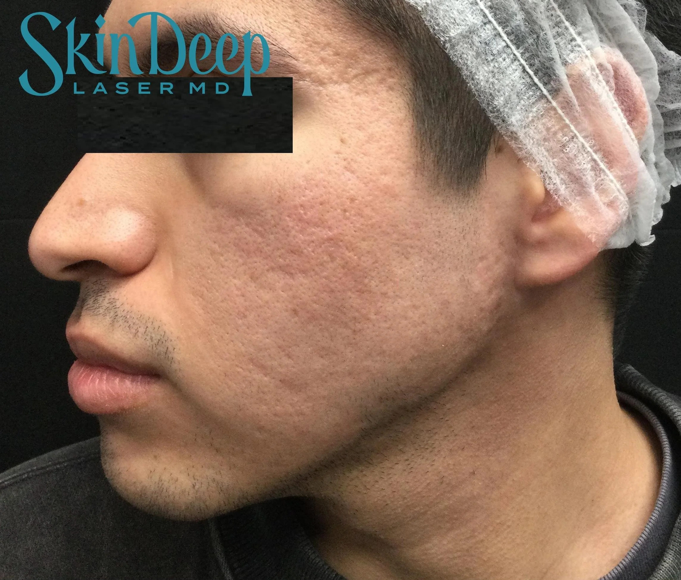 PT 049 Acne Scars 1540 Before.jpg