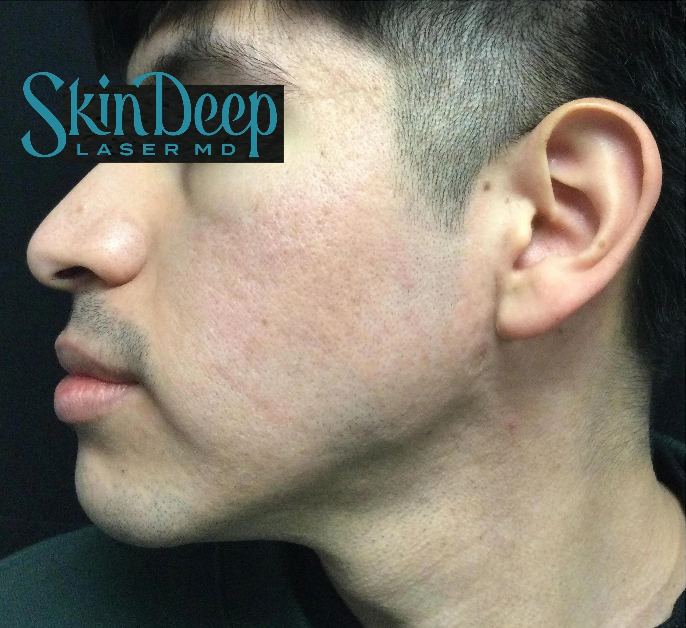 PT 049 Acne Scars 1540 Post 1 Tx.jpg