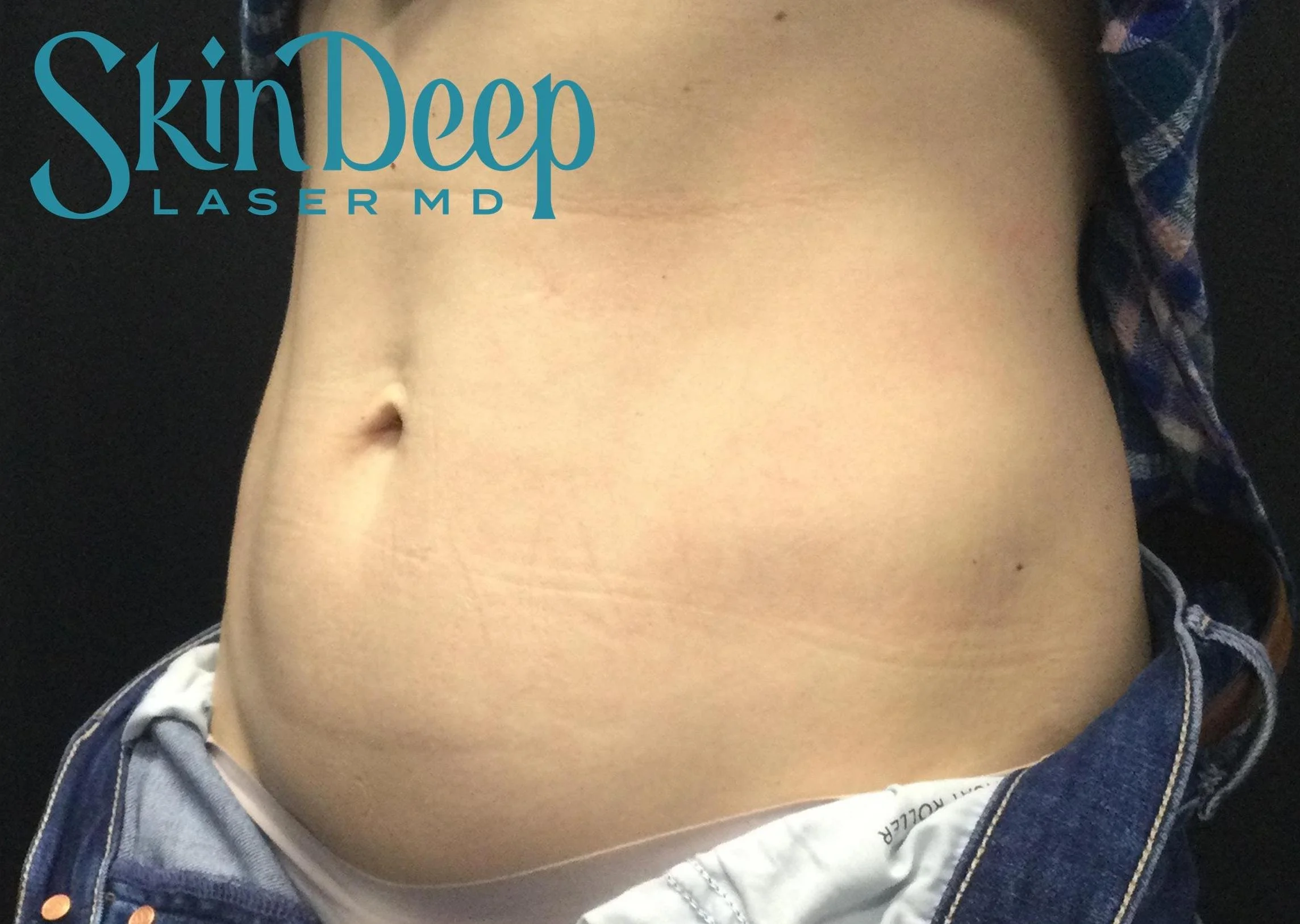 PT 054 SculpSure Before.jpg