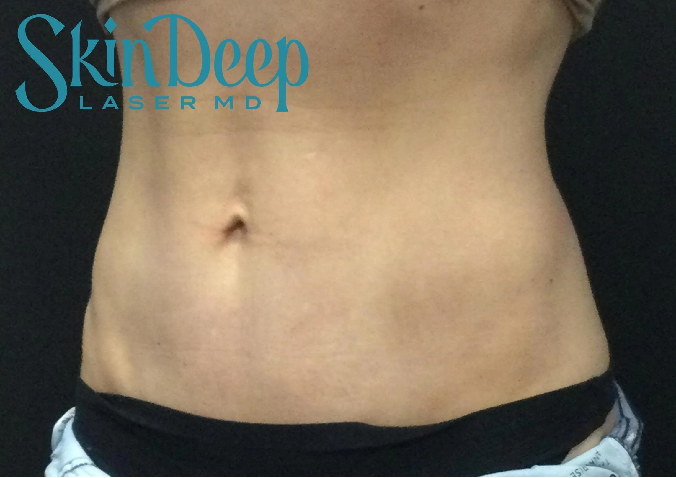 PT 054 SculpSure Post 2TX.jpg