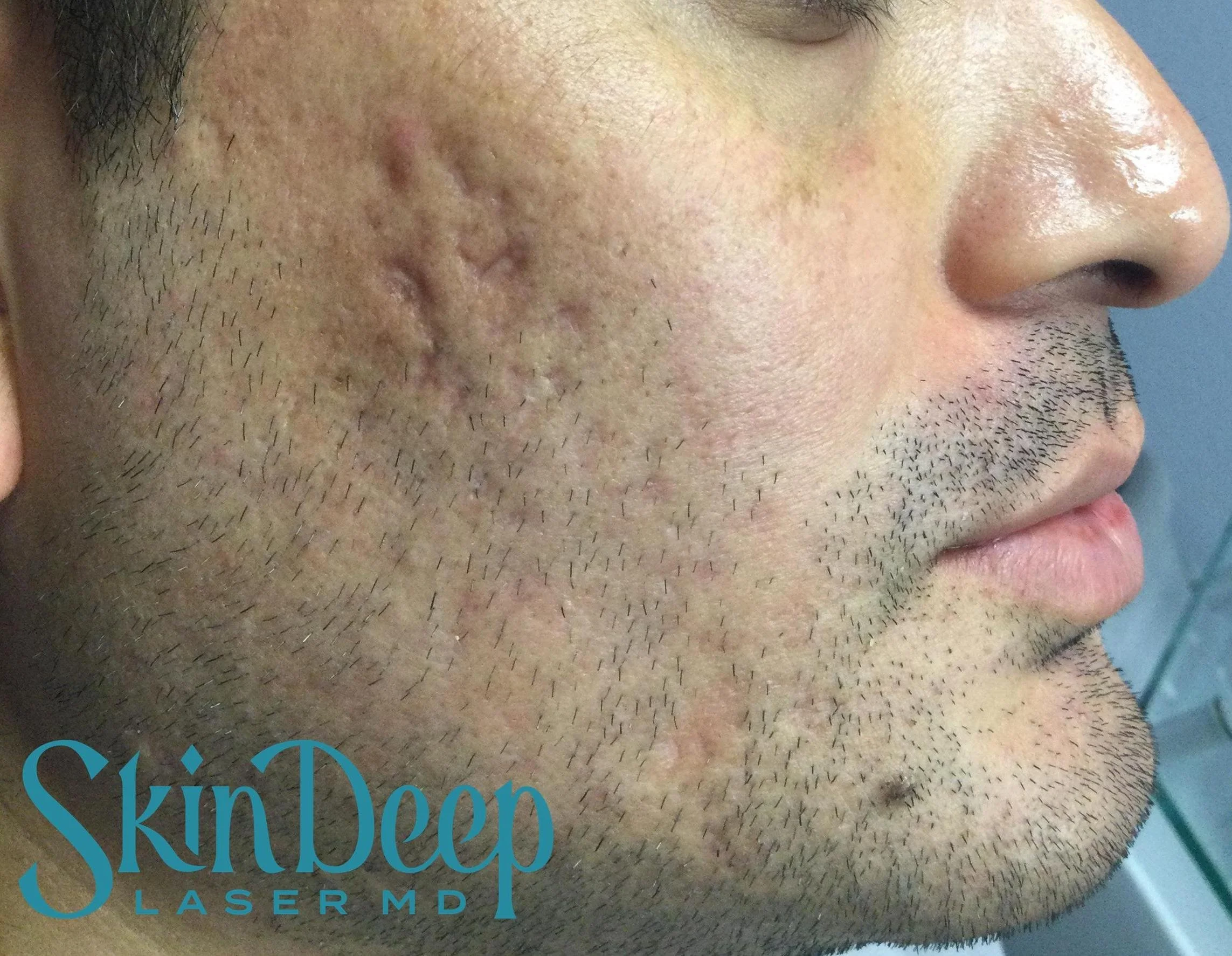 PT 057 Acne Scars Before.jpg
