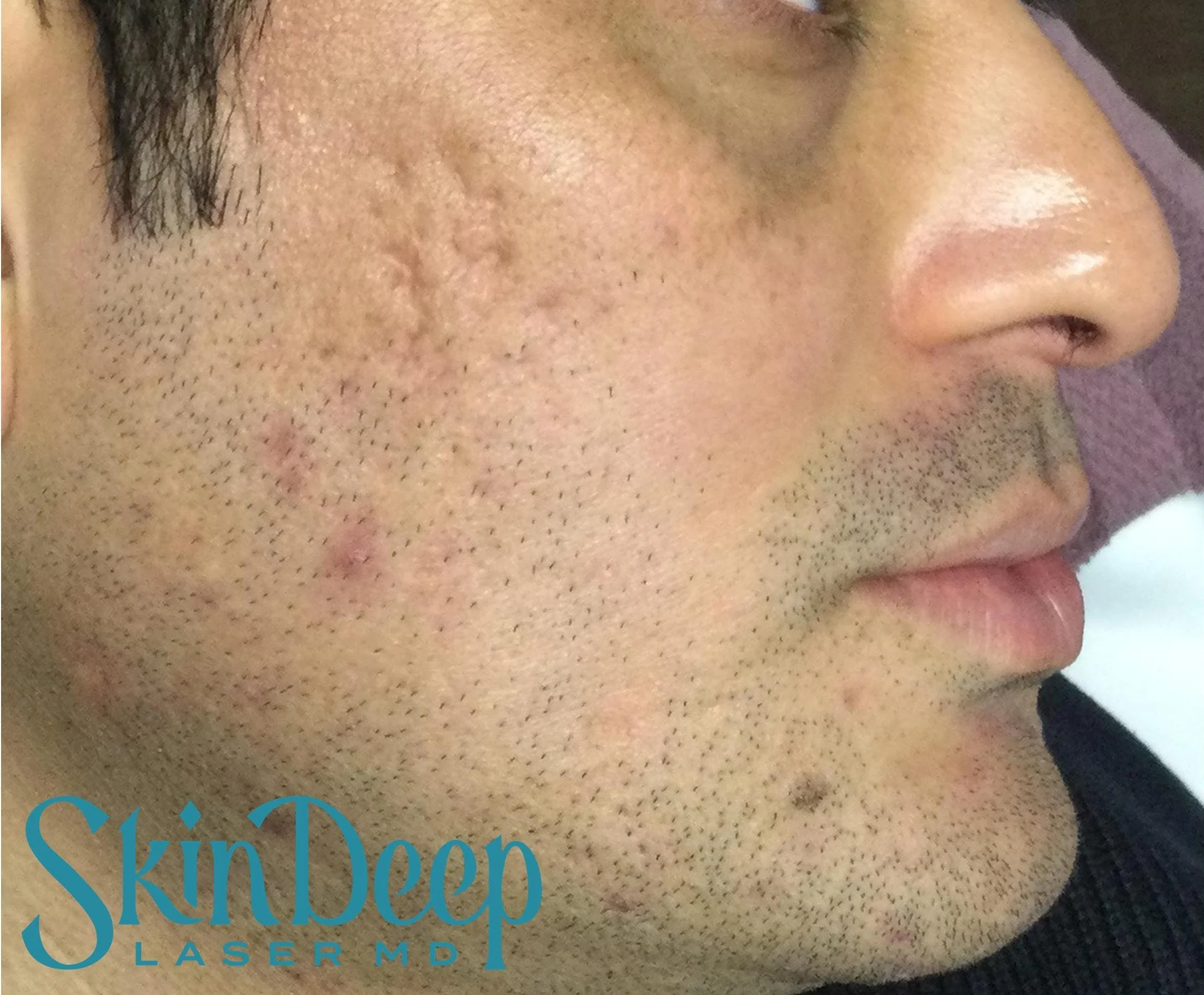 PT 057 Acne Scars Post Tx.jpg