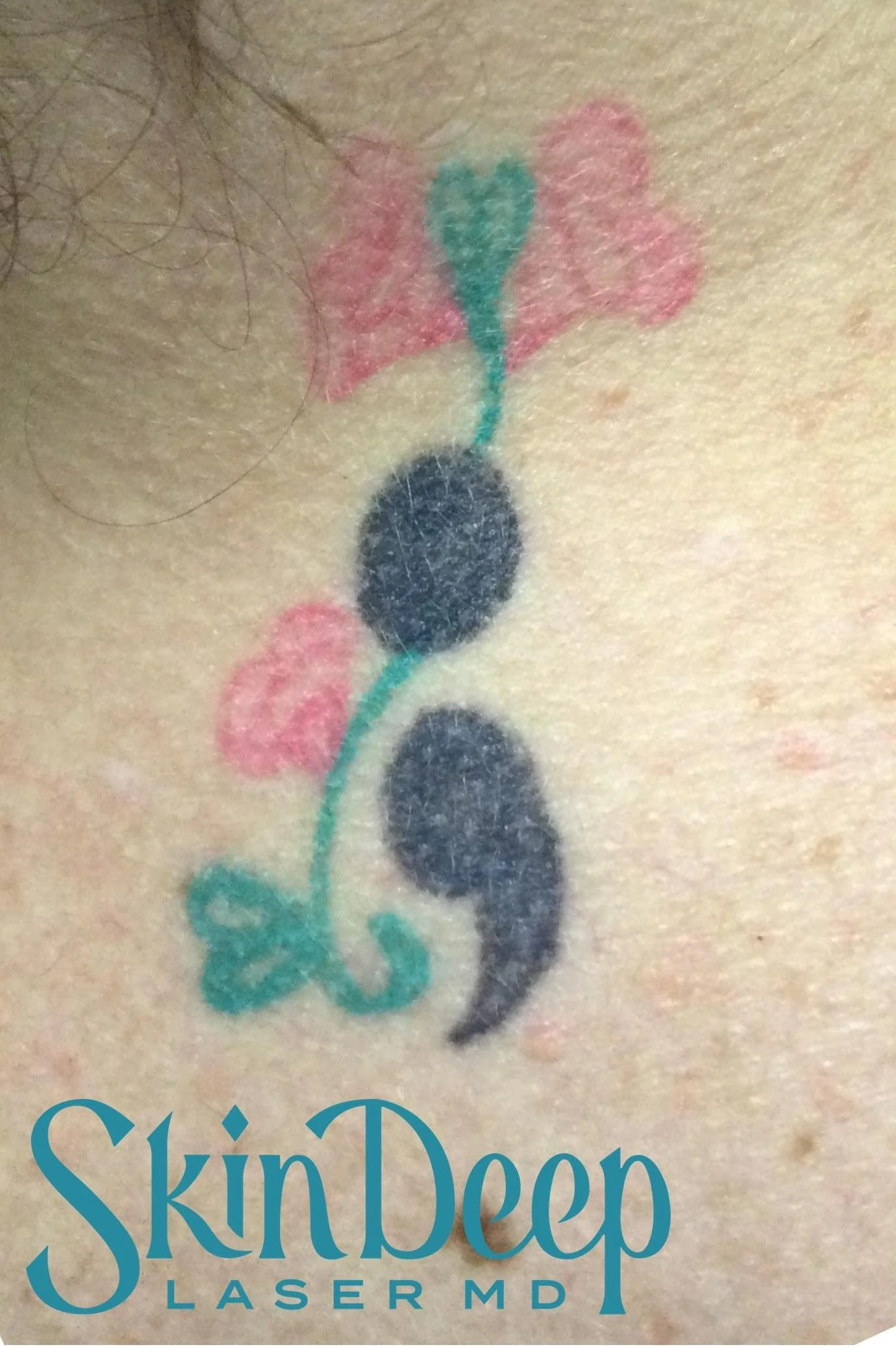 PT 058 Tattoo Before.jpg