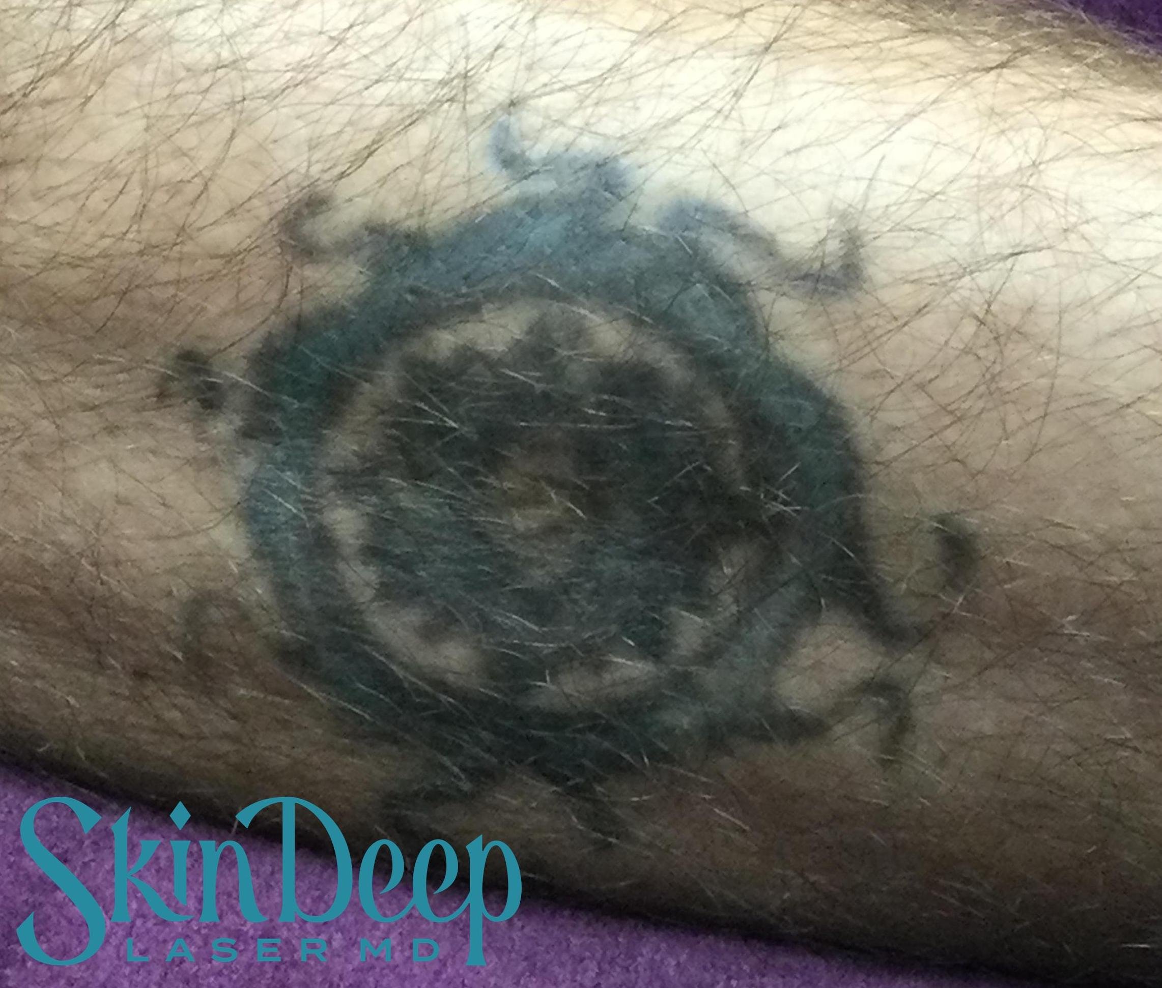 PT 059 Tattoo Before.jpg
