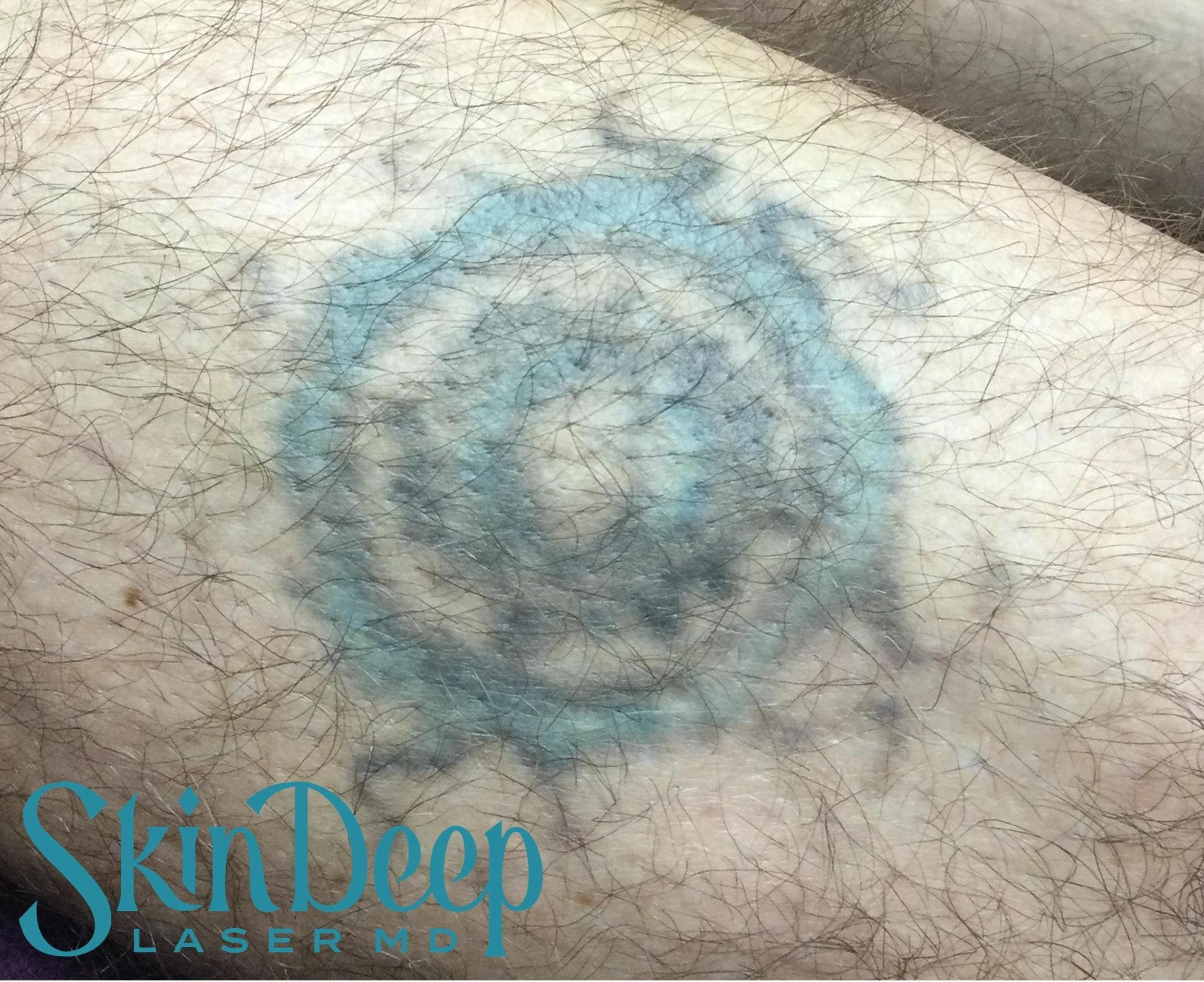 PT 059 Tattoo Post 4Tx.jpg