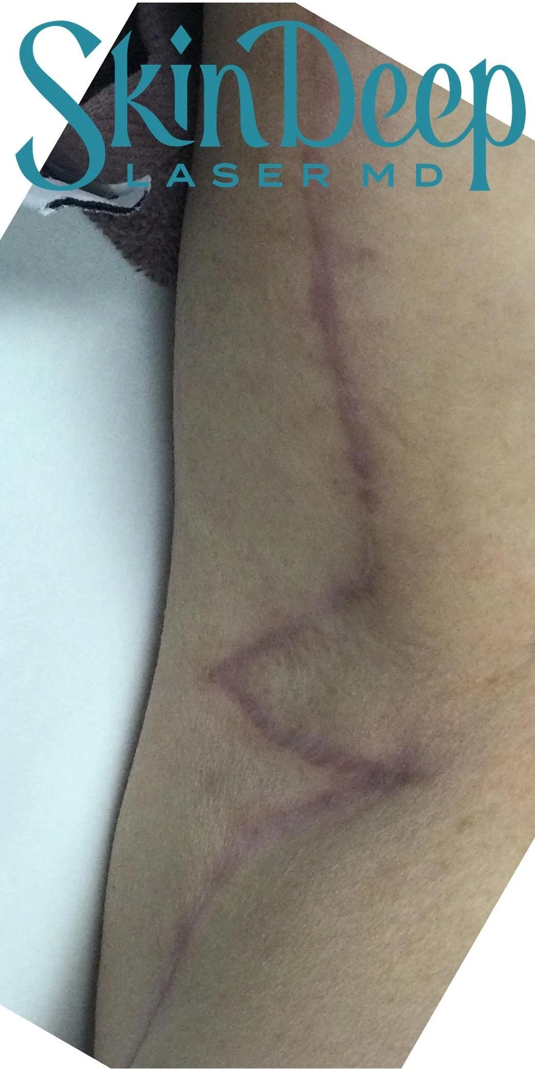 PT 062 Surgical Scar Before.jpg