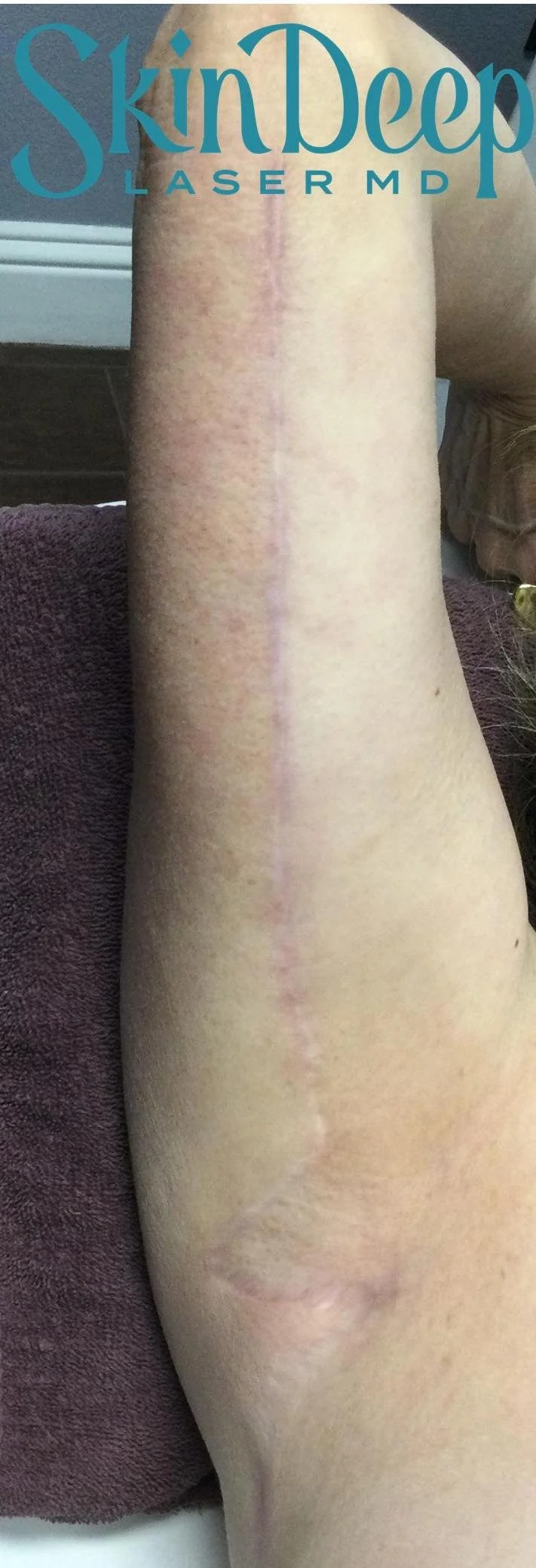 PT 062 Surgical Scar Post 4Tx.jpg