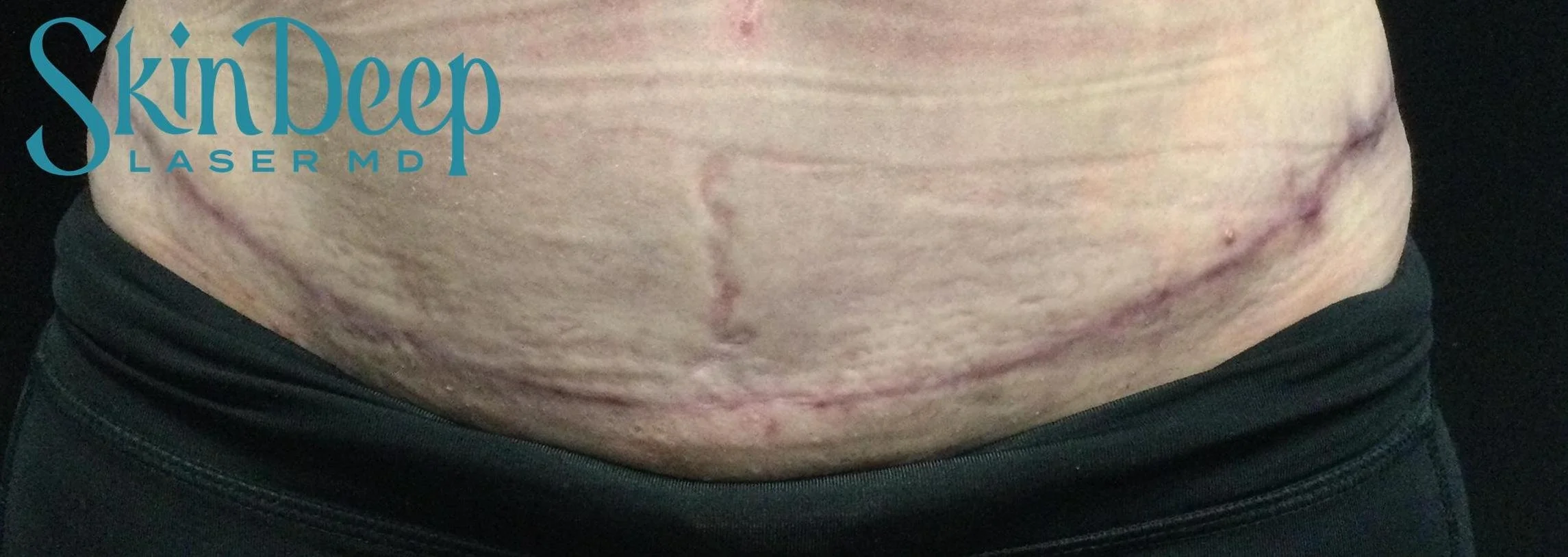 PT 063 Surgical Scar Before.jpg