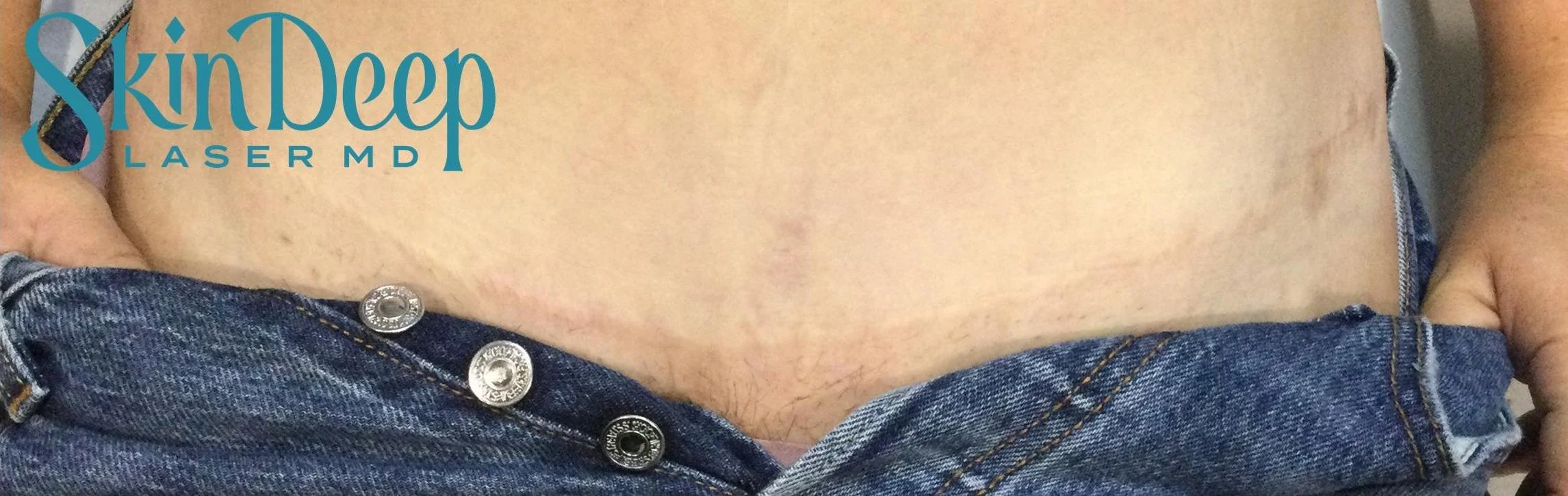 PT 063 Surgical Scar Post Tx.jpg