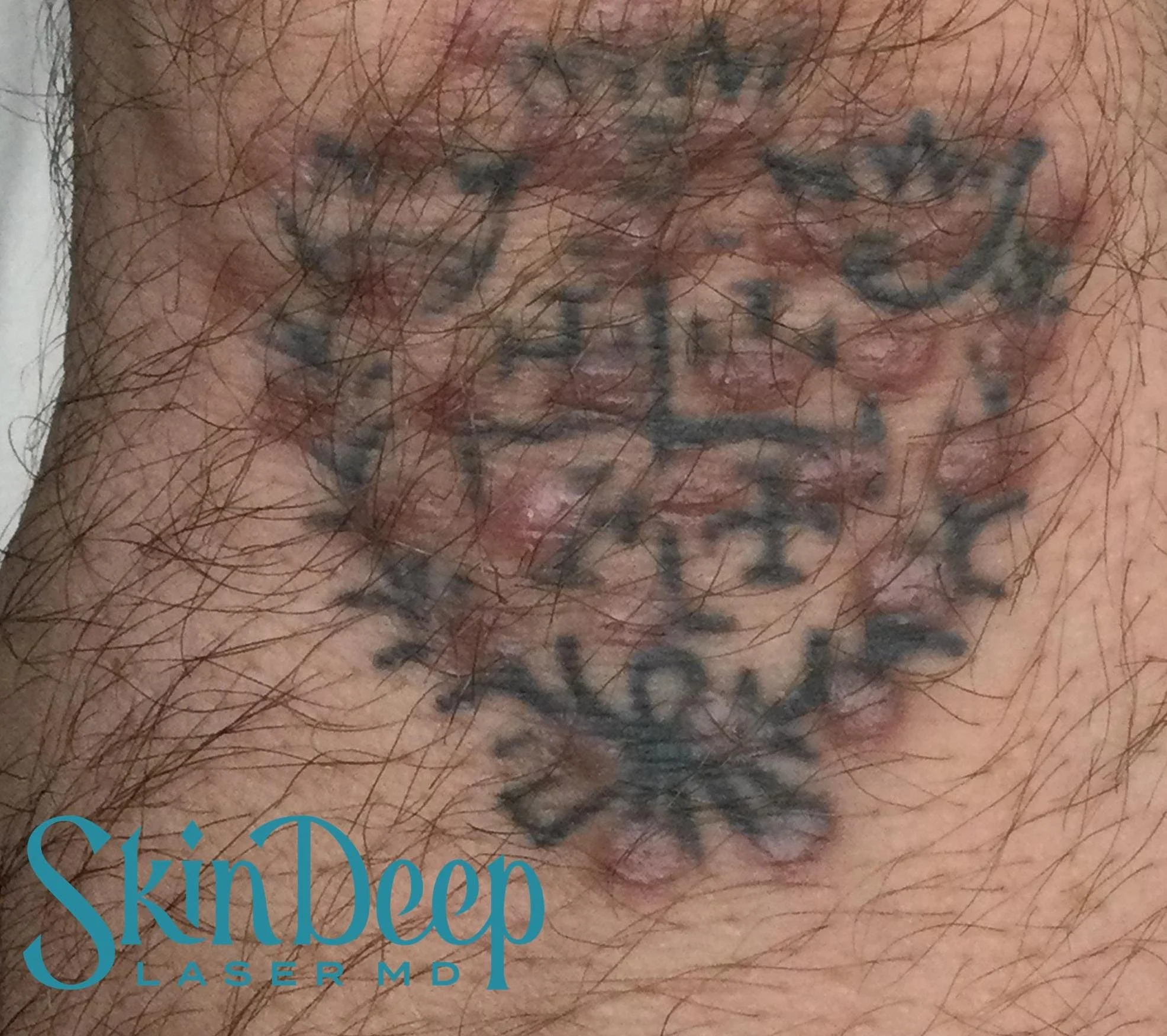 PT 063 Tattoo Before.jpg