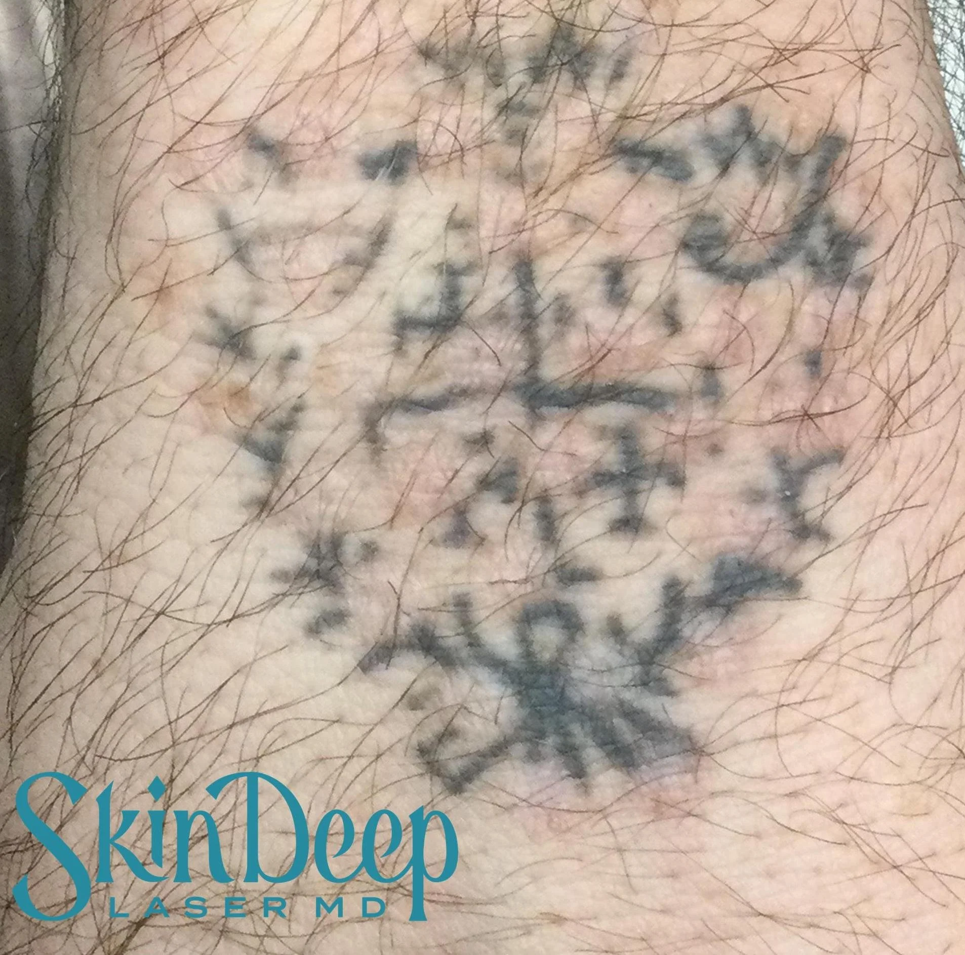 PT 063 Tattoo Post 3Tx.jpg