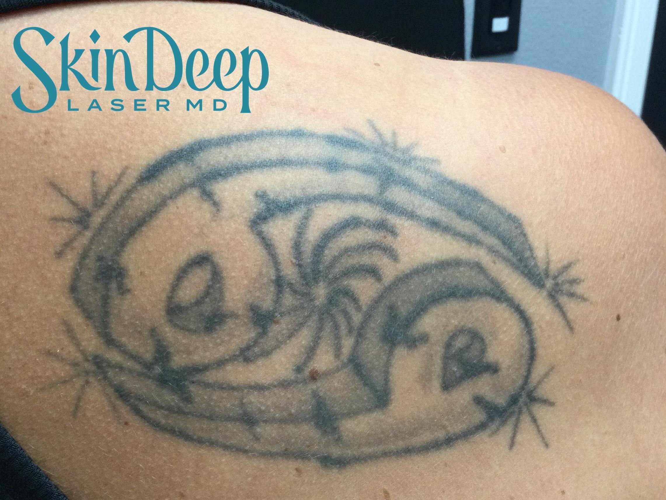 PT 066 Tattoo Before.jpg