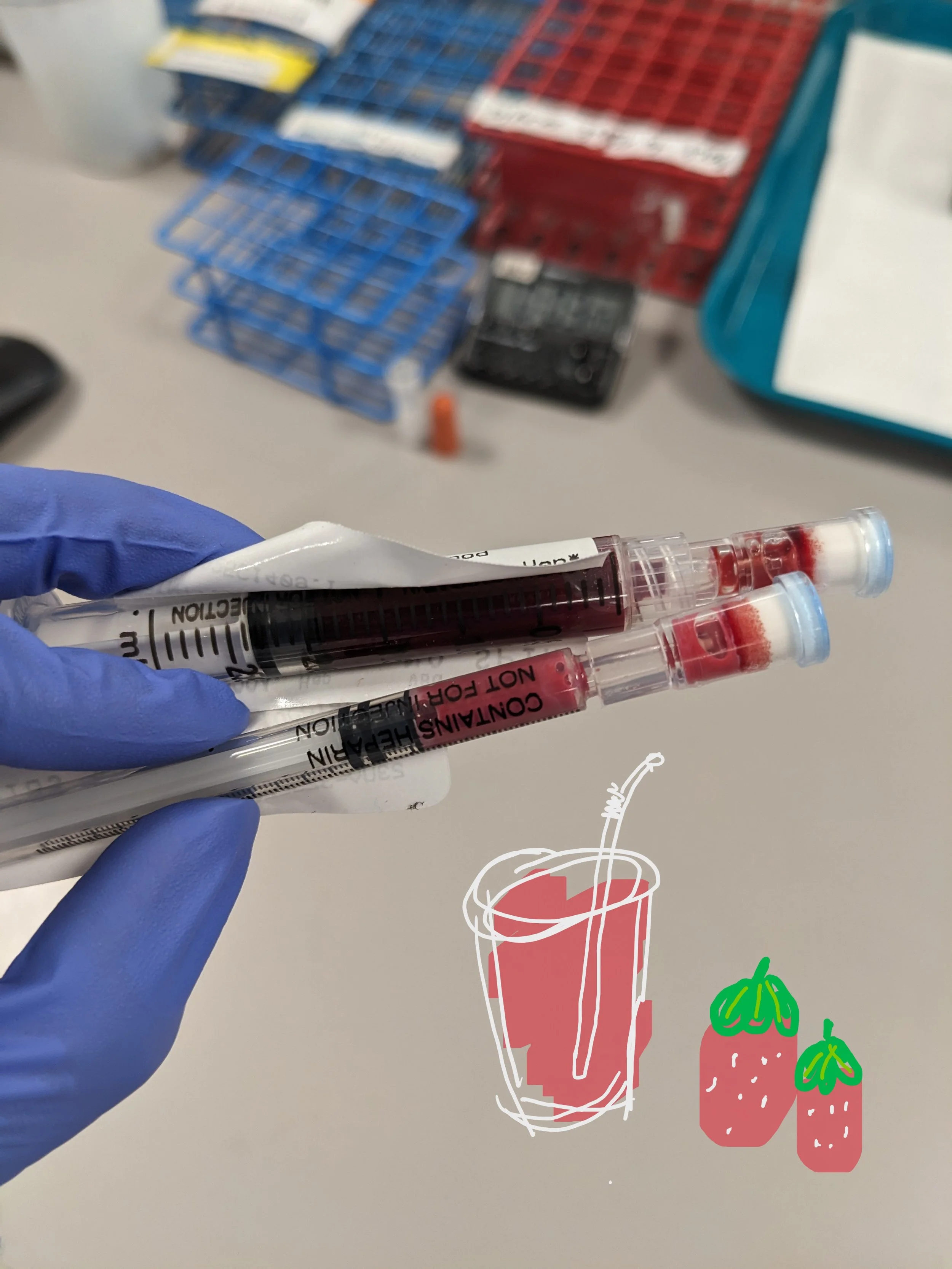 “Strawberry Milkshake Blood”: A Real Lab Story About Lipemia and Why Med Tech Judgment Matters