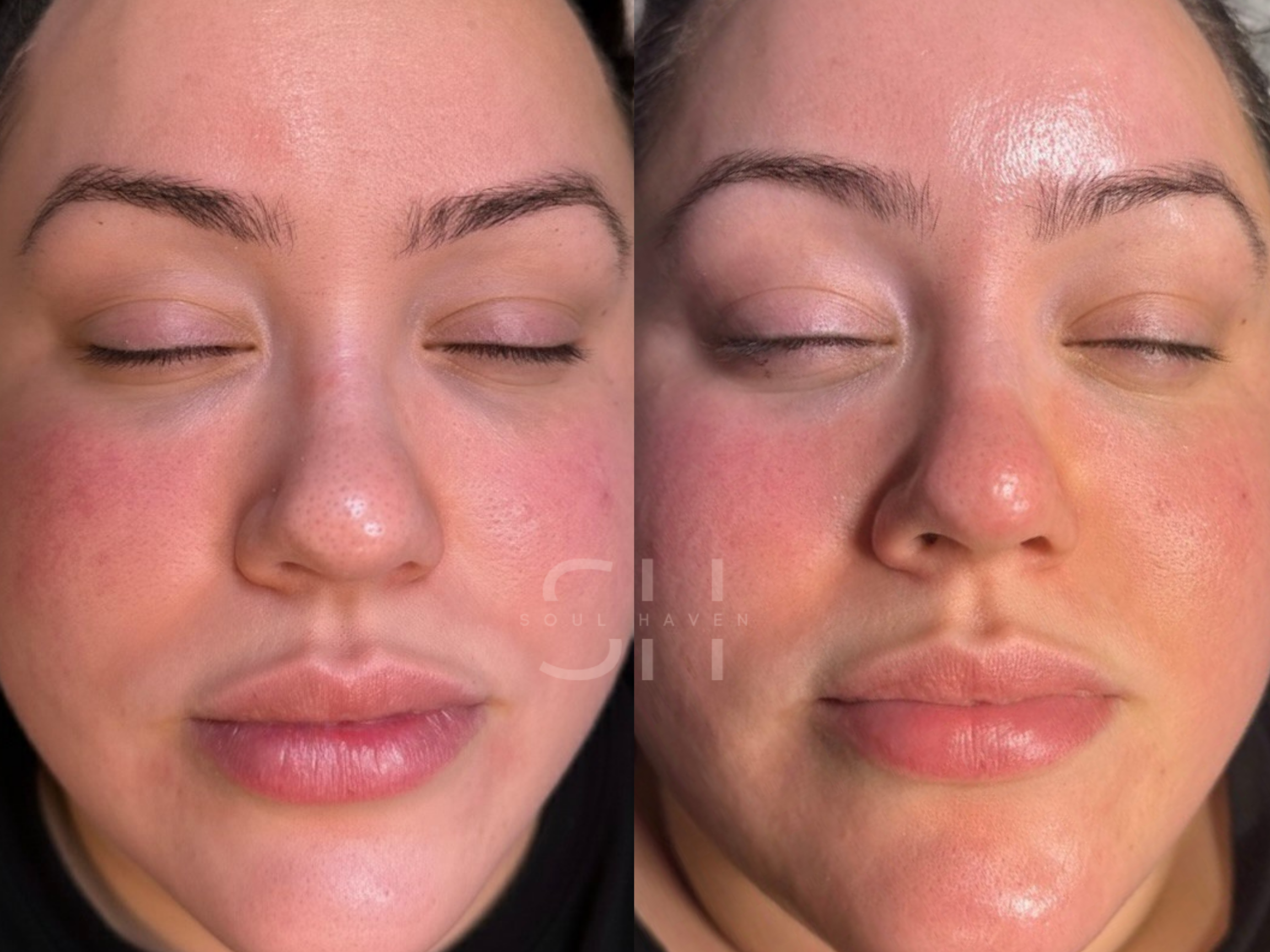 HydroFacials
