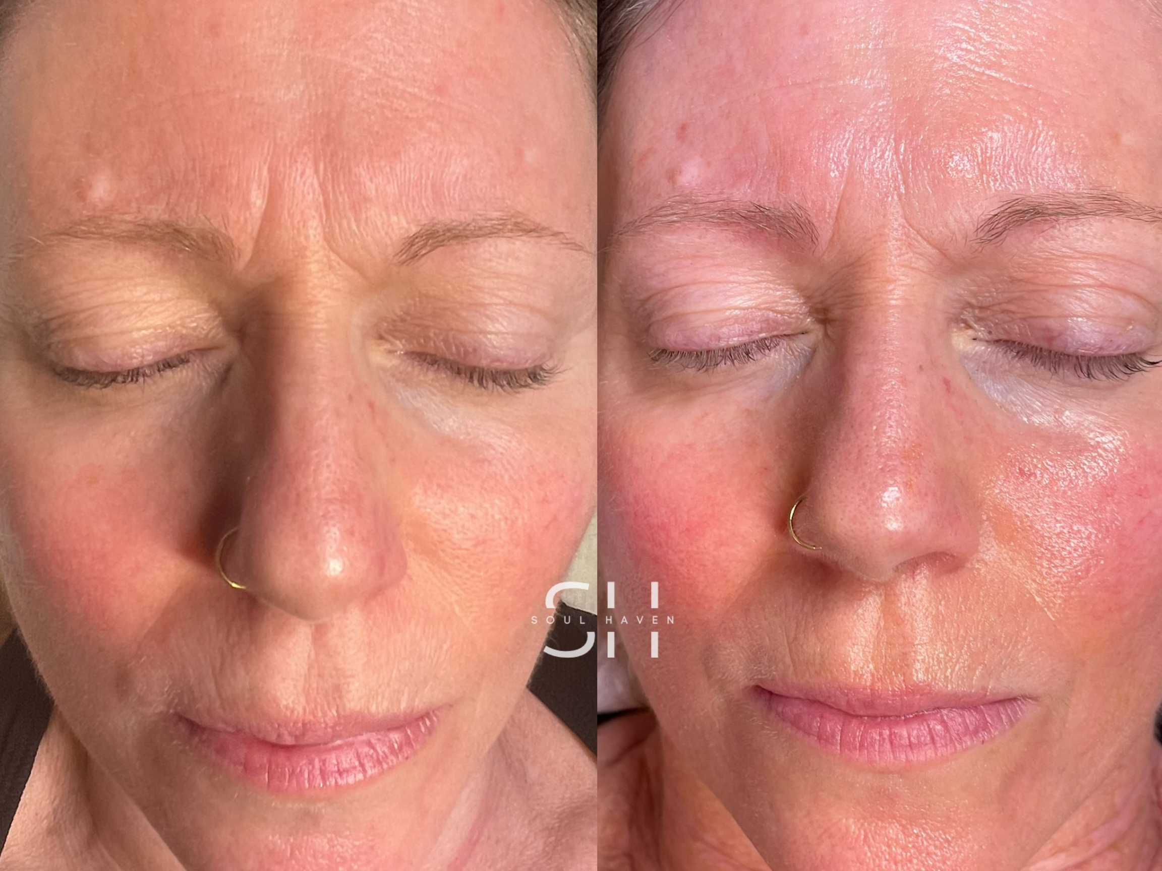 Skin Reset Series (Skin Renewal Peel)