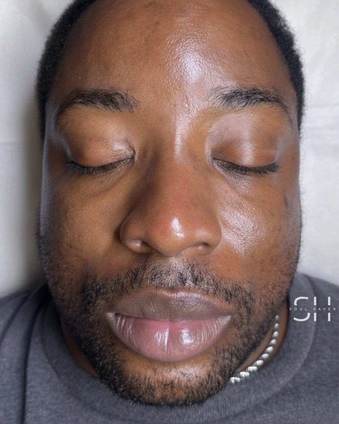 After HydroFacial Treatment
Results captured immediately following the service.