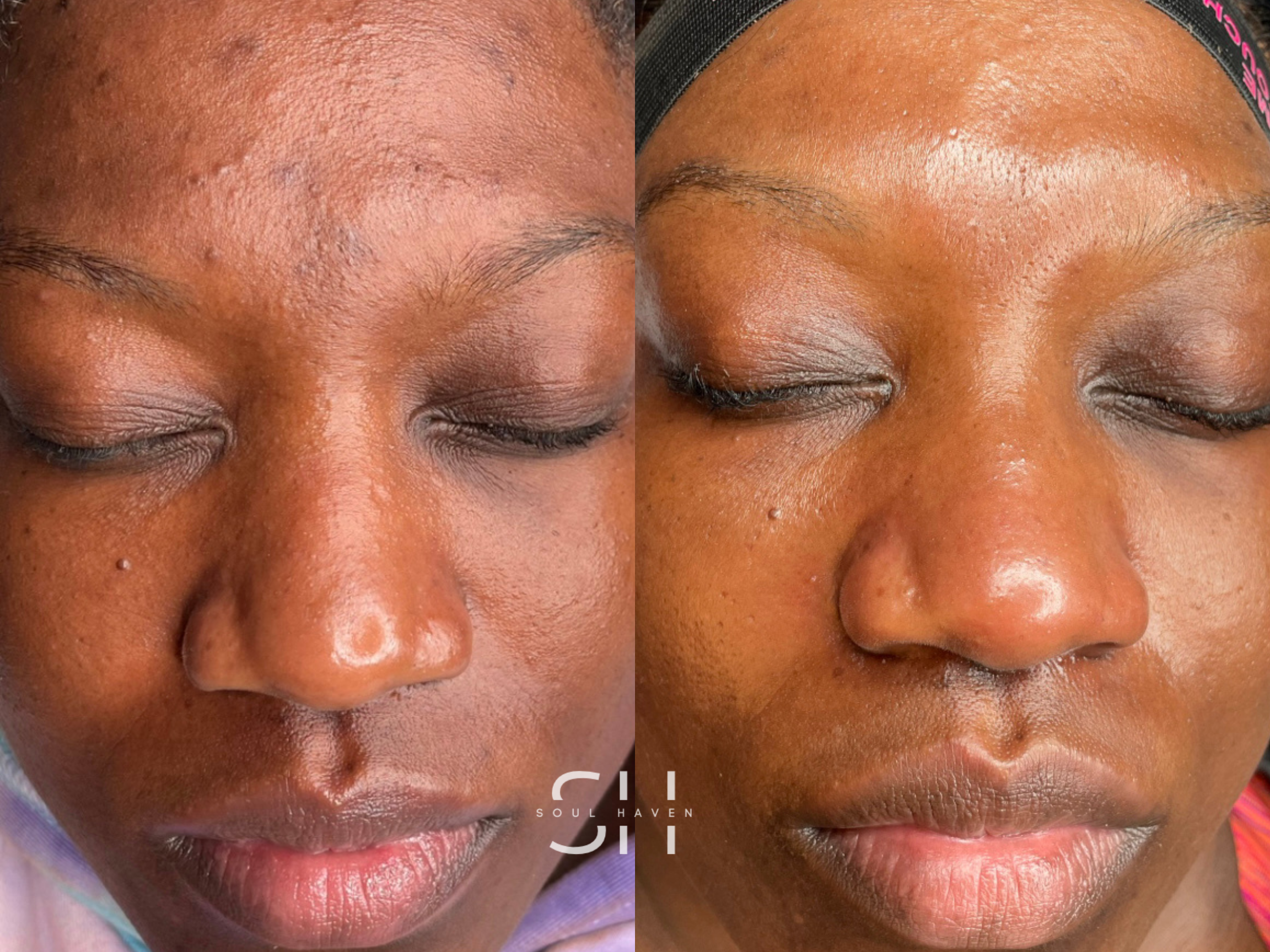 After HydroFacial Treatment