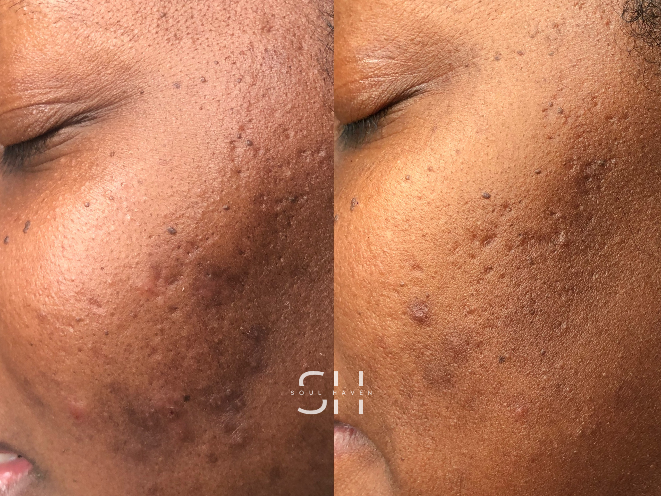 Skin Reset Series (GetGlowing Peel)