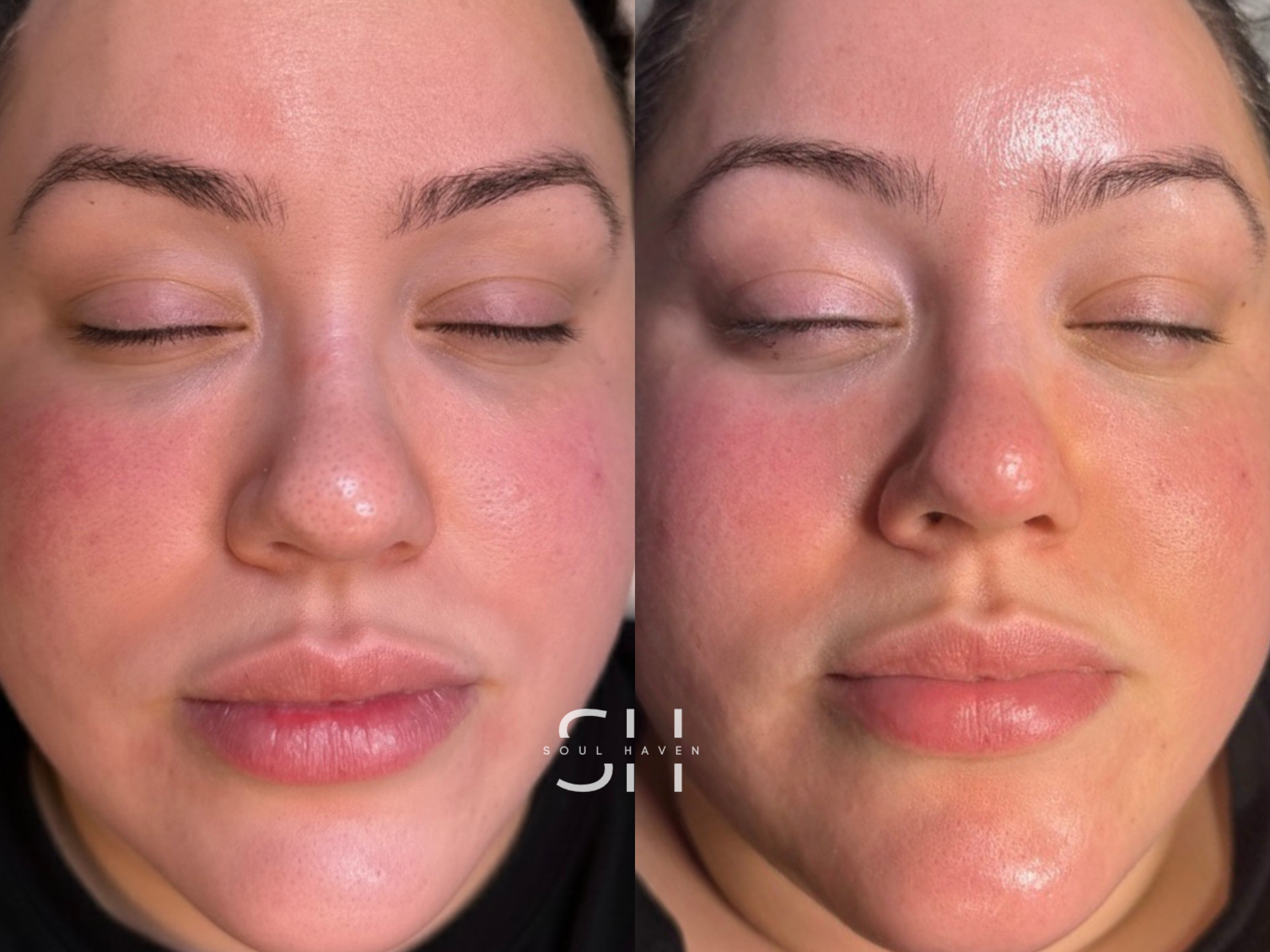 After HydroFacial Treatment 