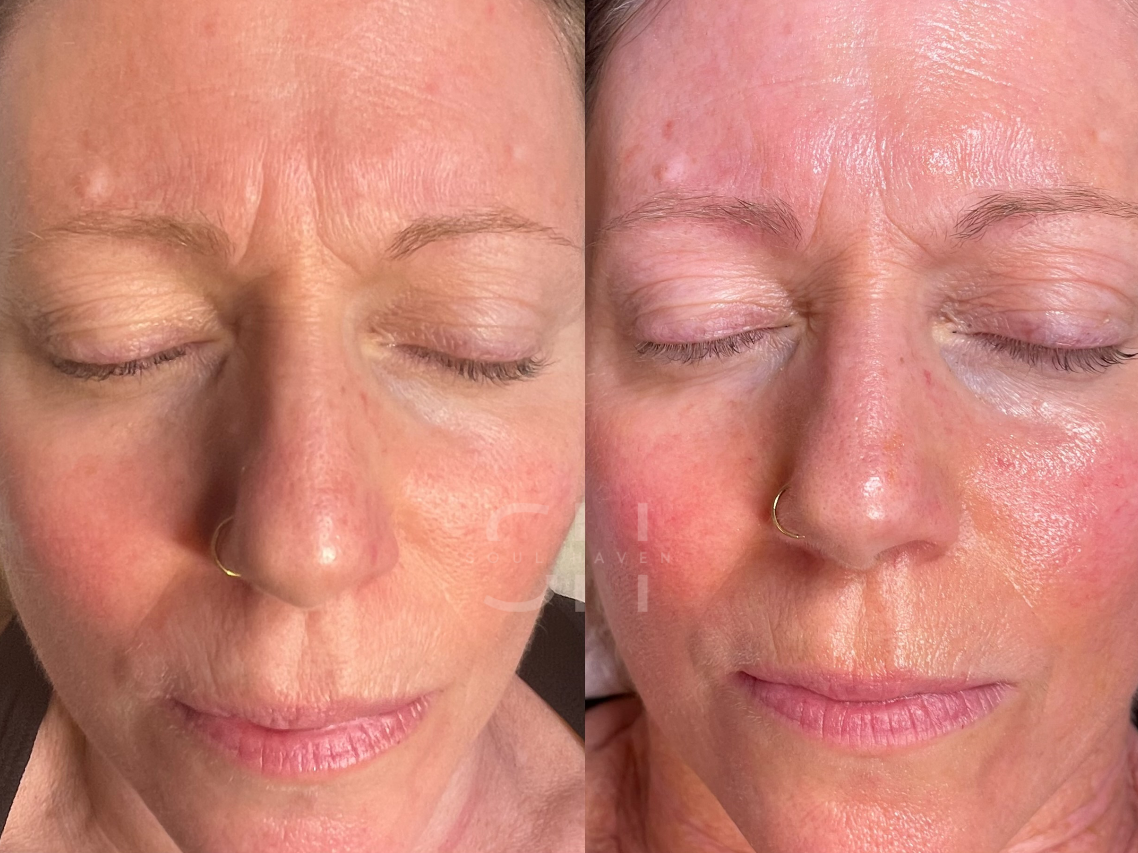 Skin Reset Series (Skin Renewal Peel)