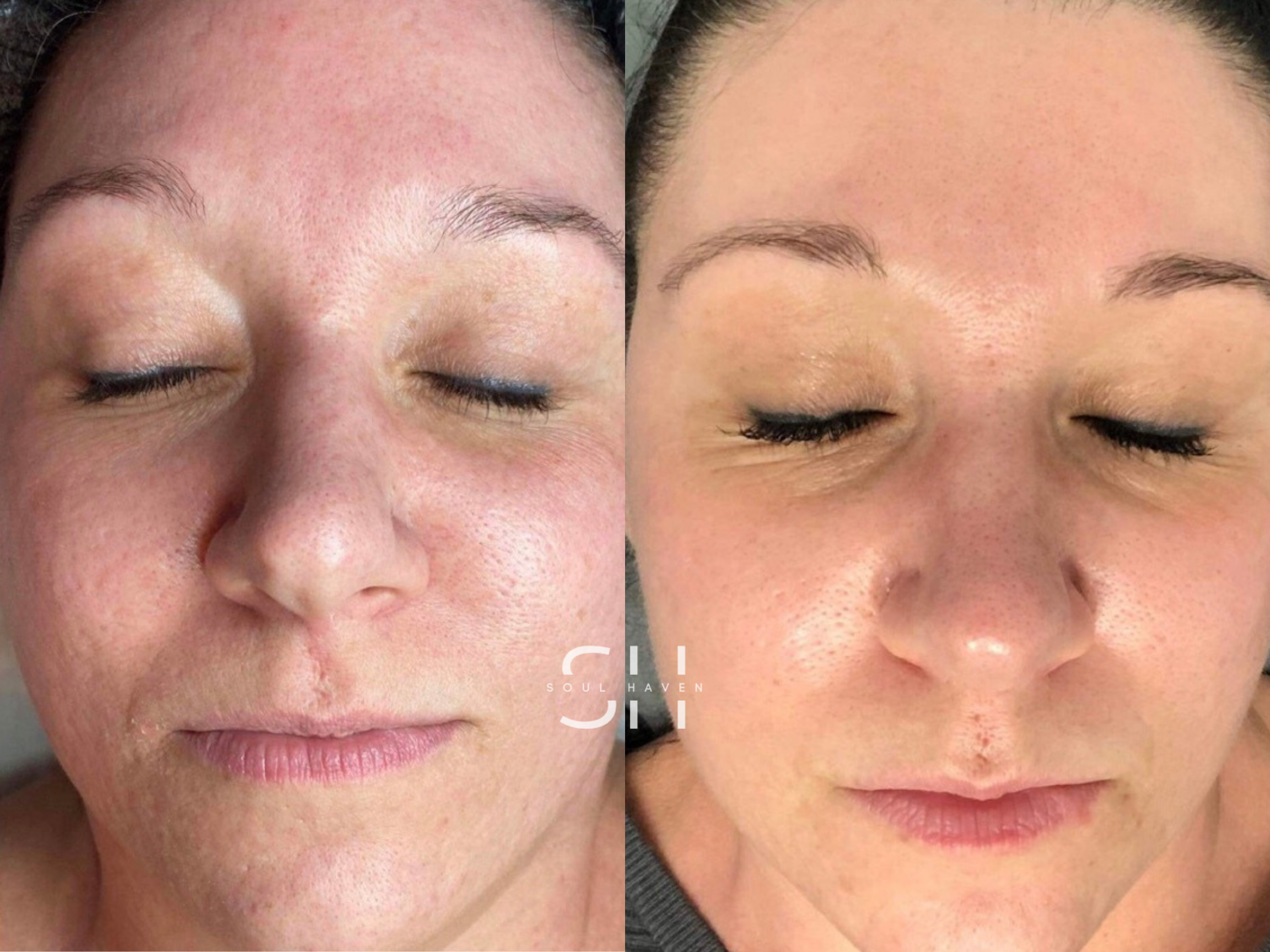 Skin Reset Series (Skin Renewal Peel)