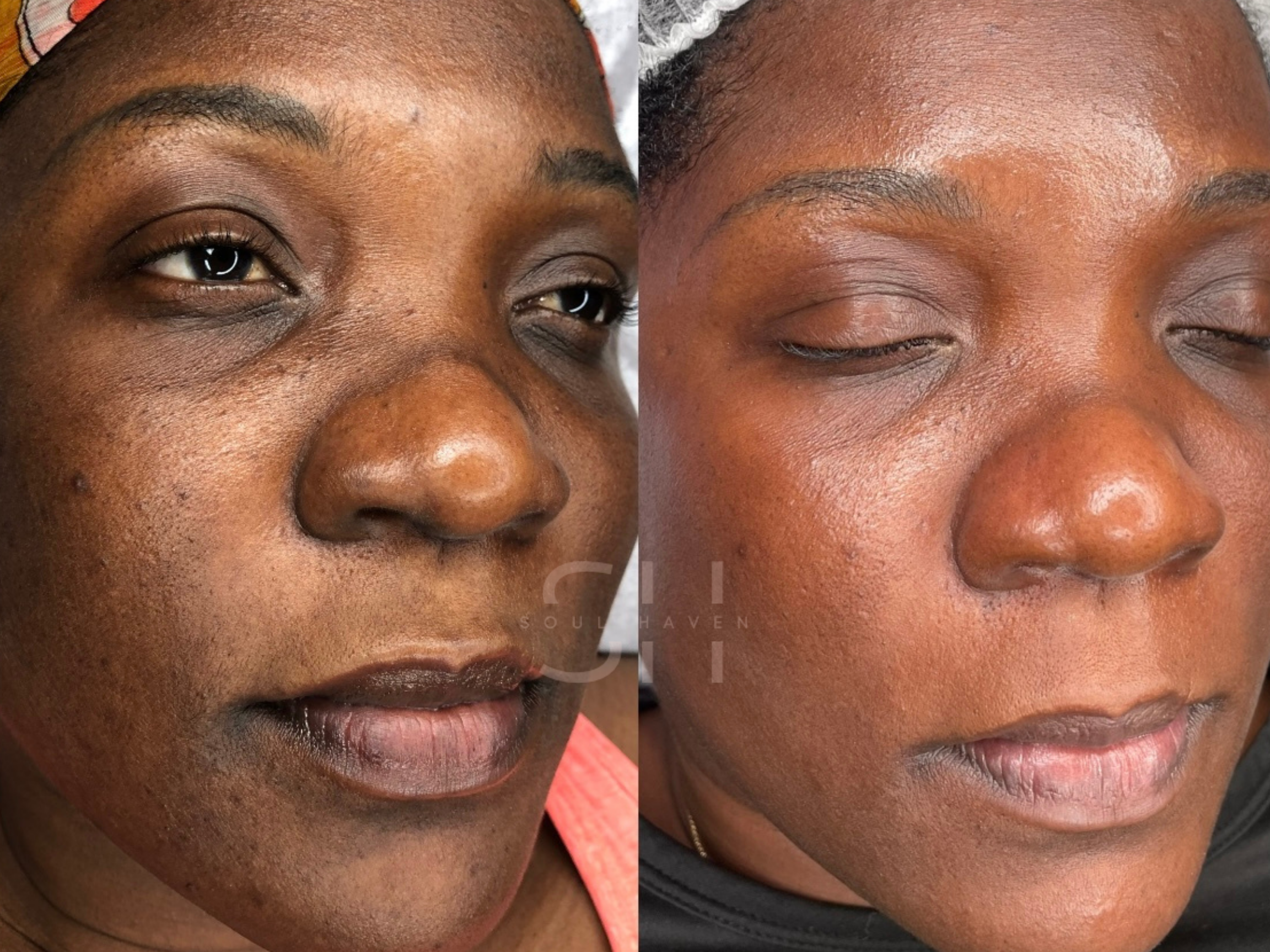 Skin Reset Series (Skin Renewal Peel)