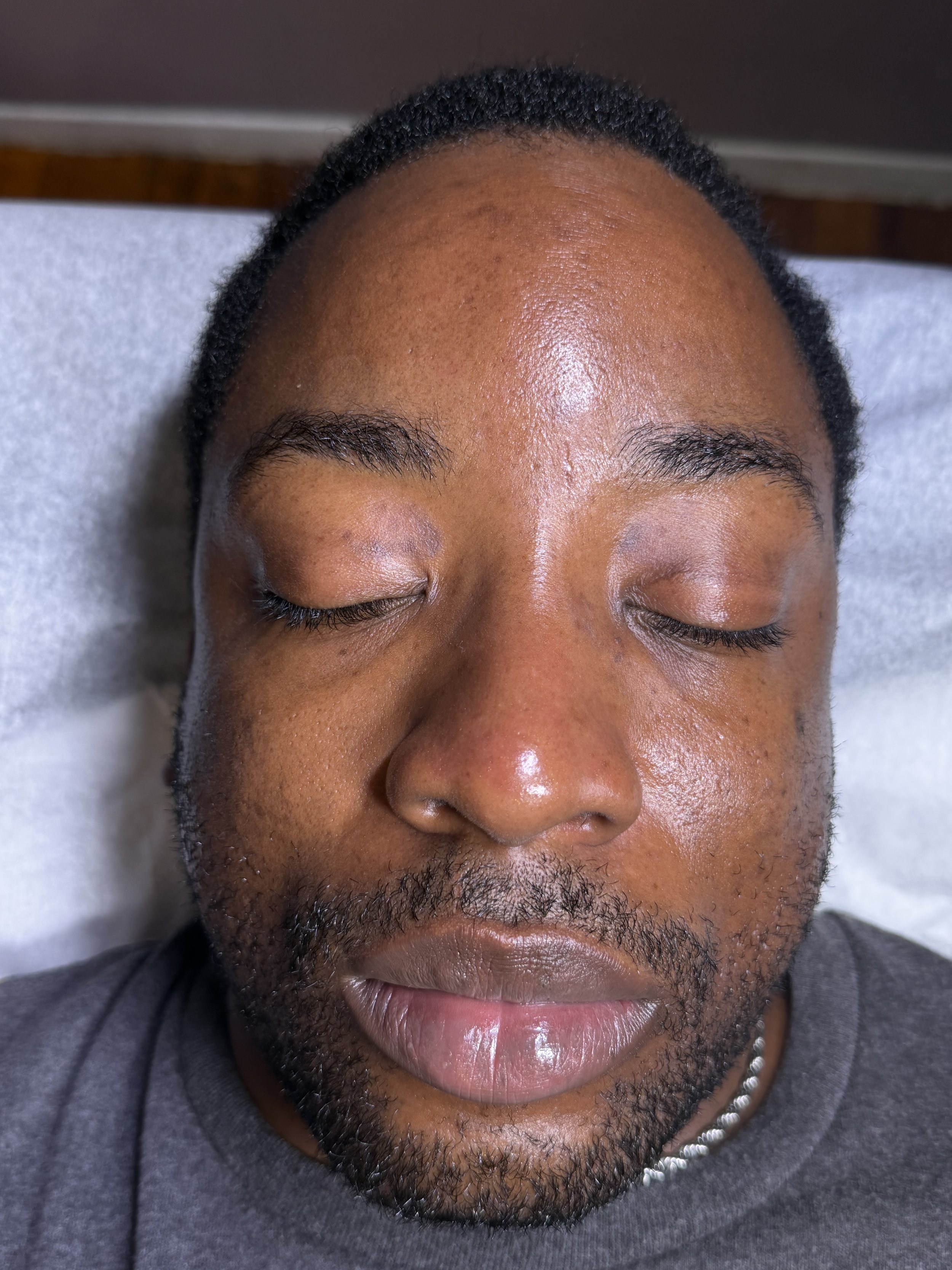 After HydroFacial Treatment Results captured immediately following the service.