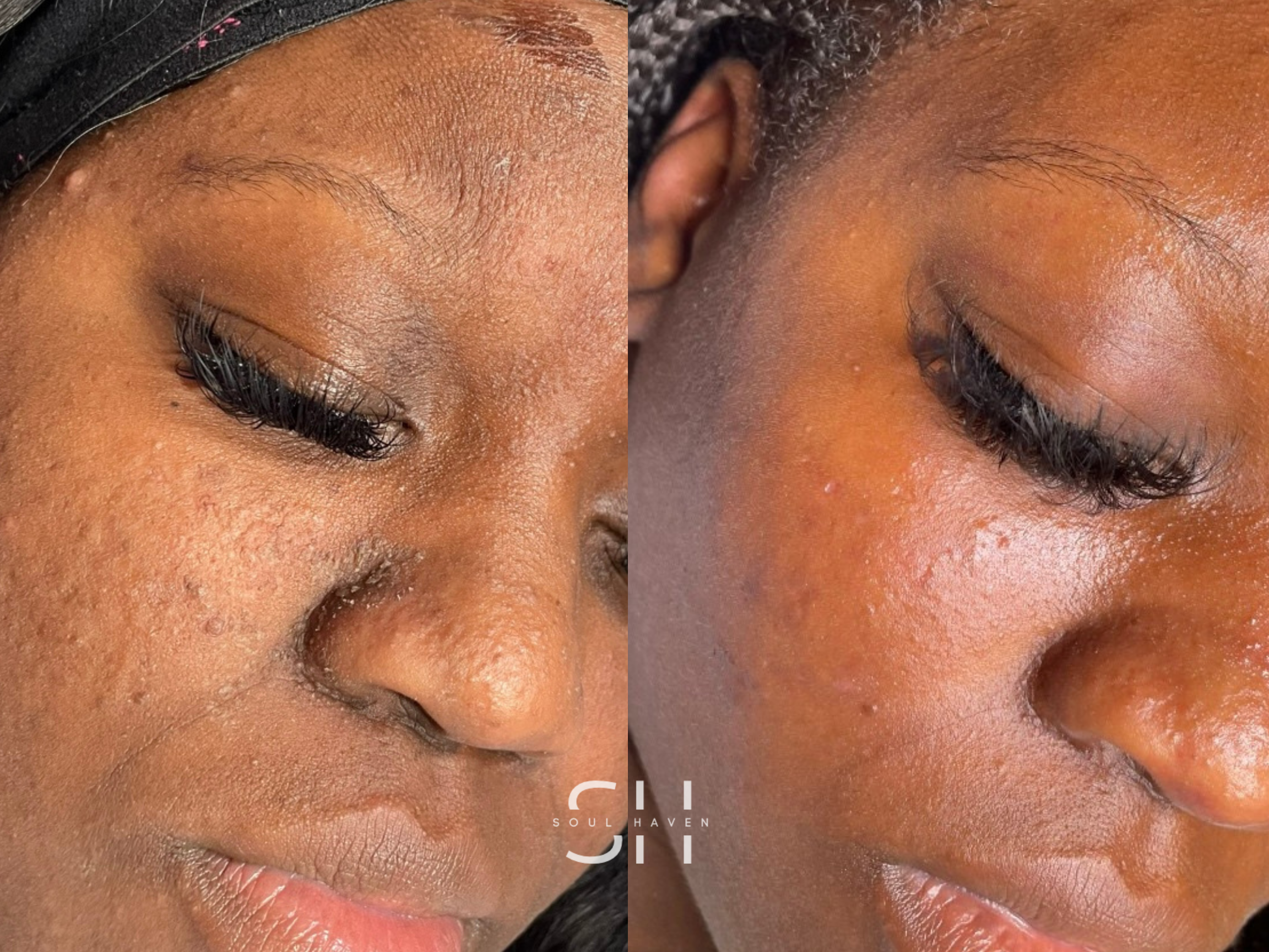 Skin Reset Series (GetGlowing Peel)