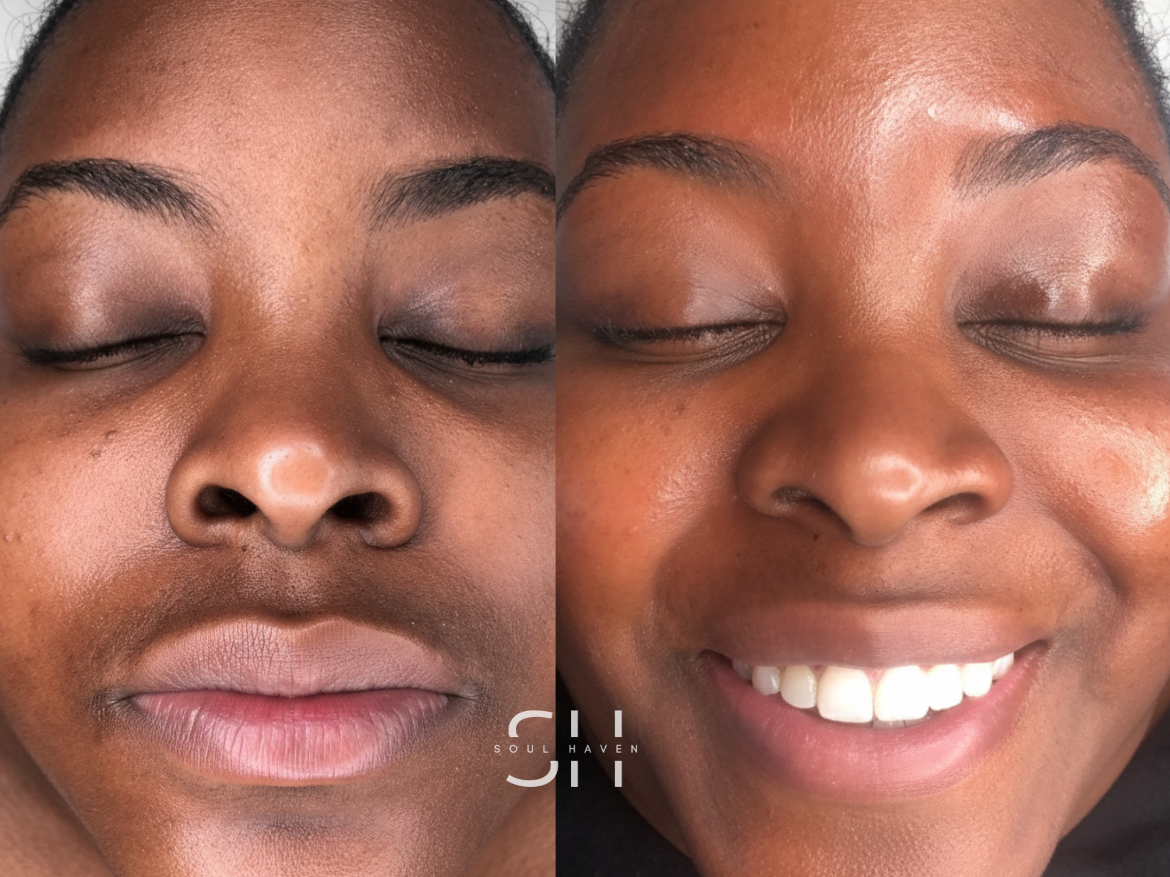After HydroFacial Treatment 