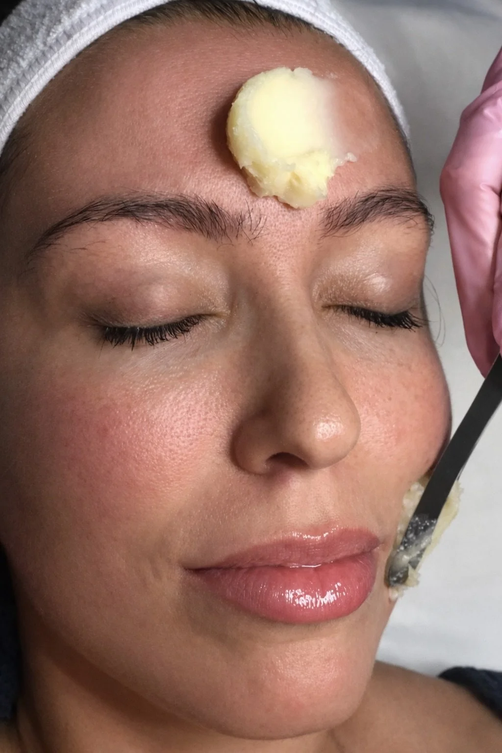 Get Glowing Peel (Treatment in progress)