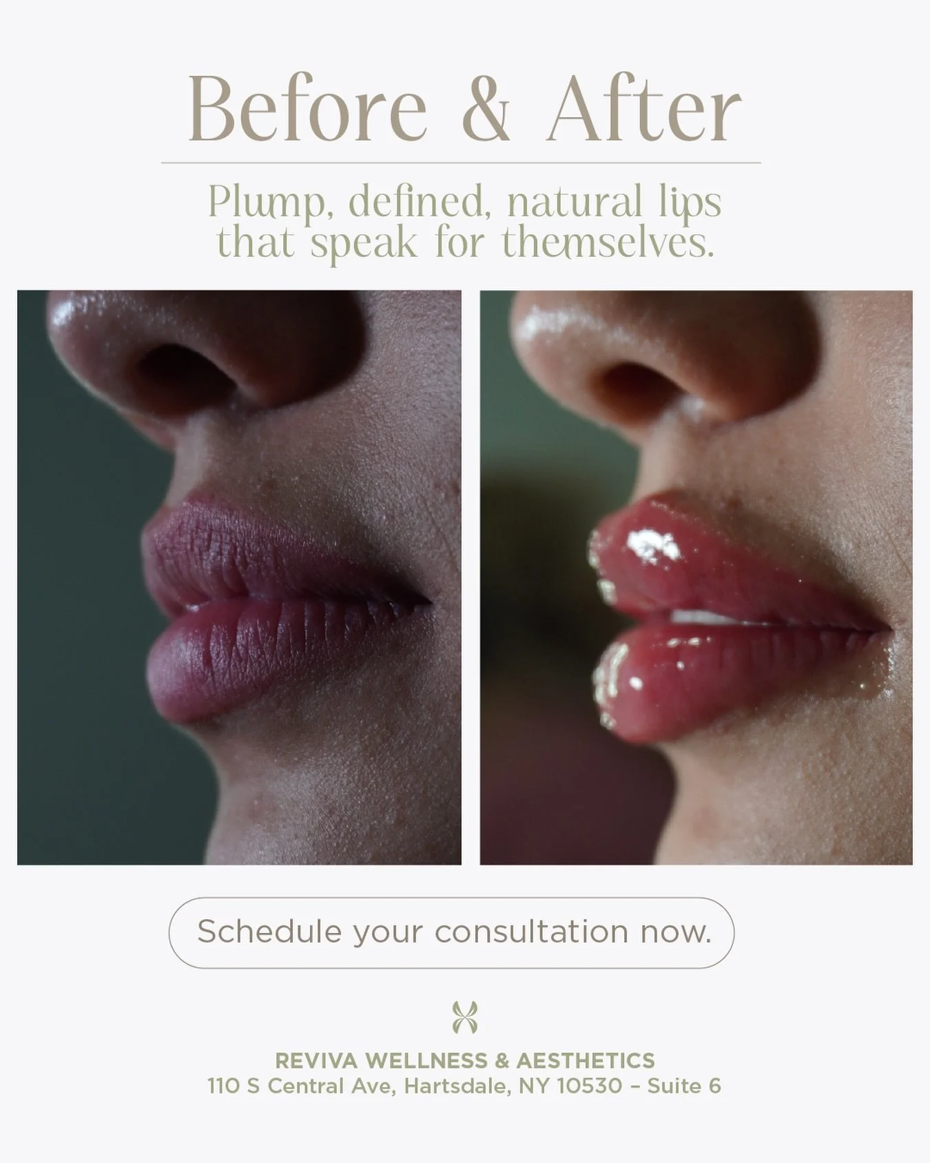 Soft volume. Perfect definition. Results you can feel &mdash; and see.
Natural lips that do all the talking.
Book your consultation today 💋

📍 REVIVA WELLNESS &amp; AESTHETICS
110 S Central Ave, Hartsdale, NY 10530 &ndash; Suite 6

#NaturalLips #Li