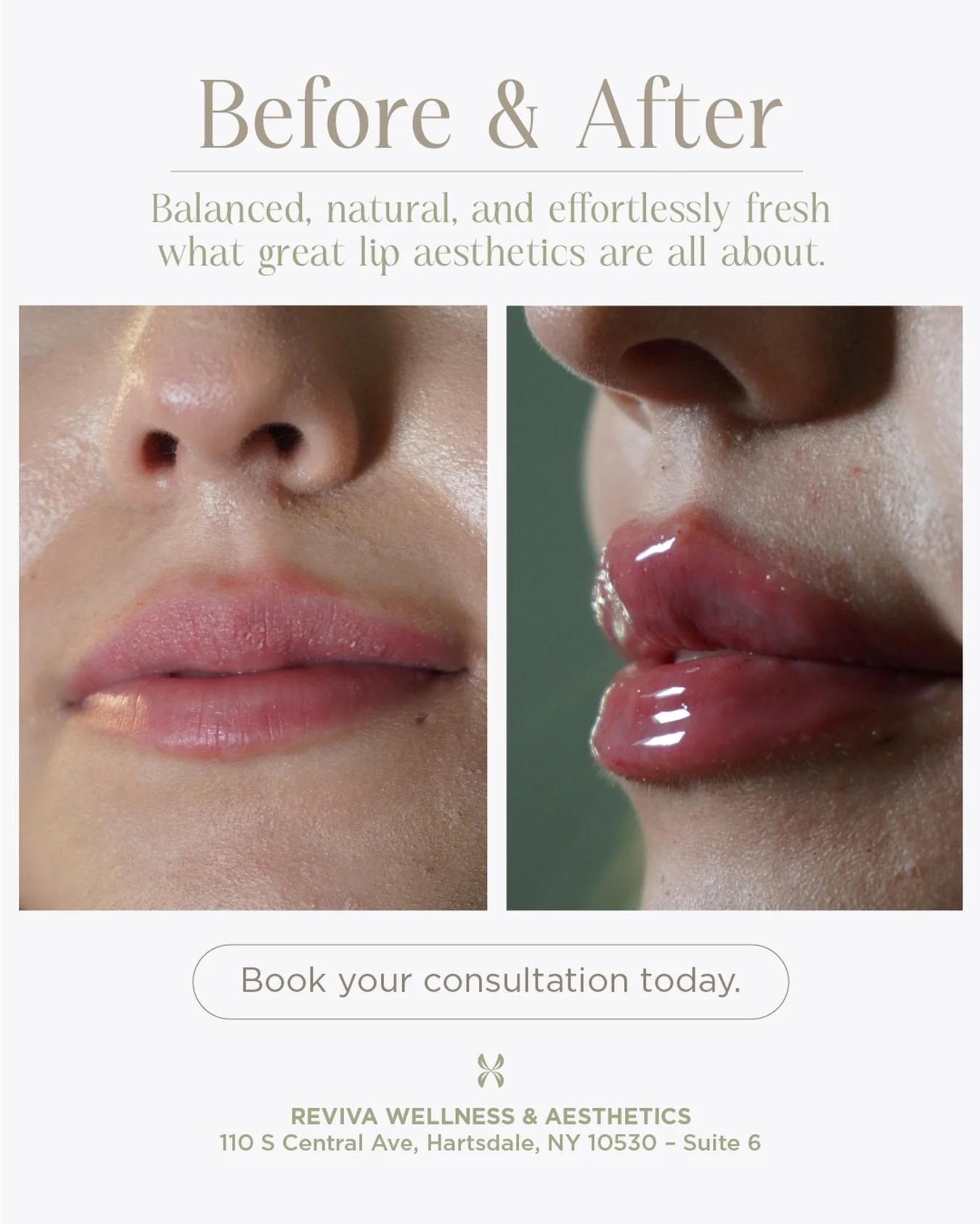 Your lips&hellip; but better. Balanced shape. Natural volume. Fresh results. ✨ Book your consultation today.

REVIVA Wellness &amp; Aesthetics
📍 Hartsdale, NY &mdash; Suite 6

#LipAesthetics #NaturalLips #LipFillerNY #AestheticClinic #RevivaWellness