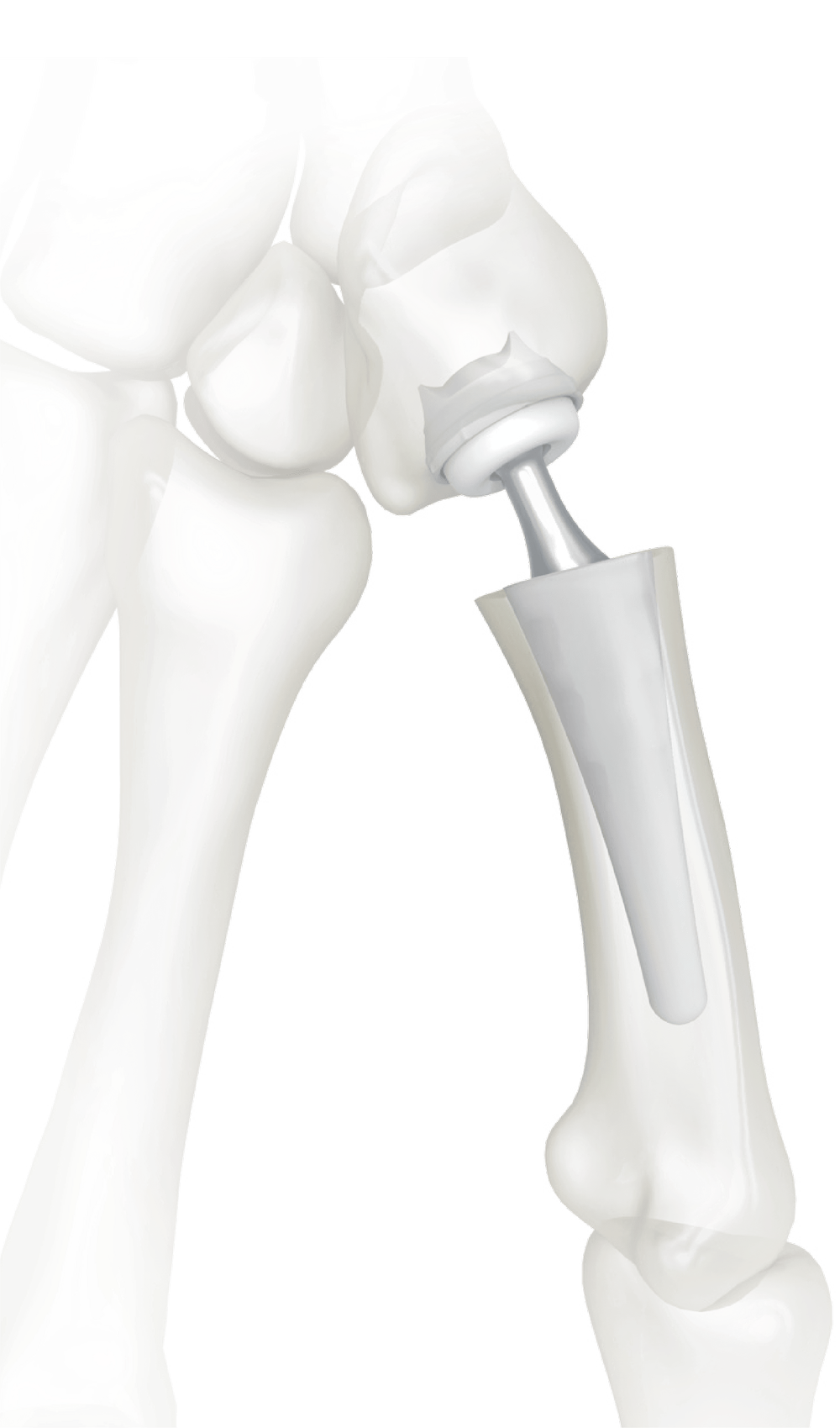1st CMC Joint Replacement for Basal Thumb Arthritis | Mr Anthony Cheng ...