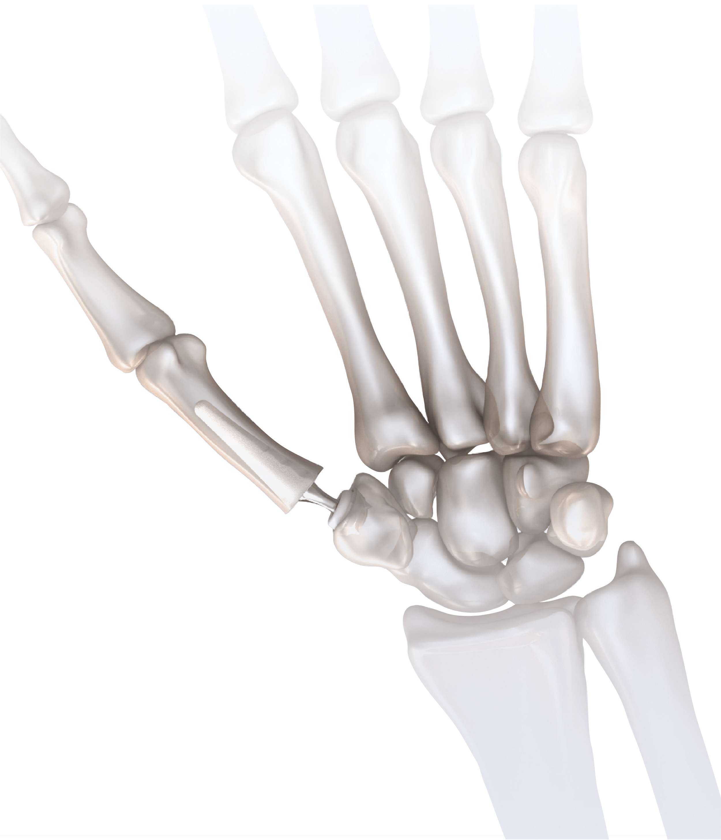 Anthony Cheng 1st CMC Joint Replacement for Thumb Arthritis Hand Render