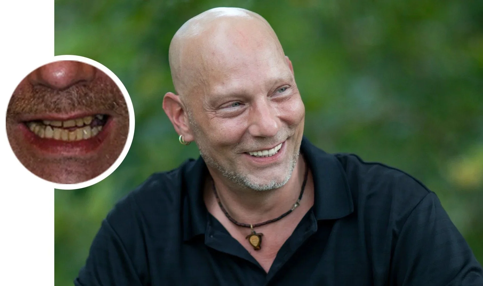 Close-up of a smiling bald man wearing earrings, a black shirt, and a necklace with a pendant, outdoors with a green background. An inset shows a close-up of a mouth with yellowed, crooked teeth.