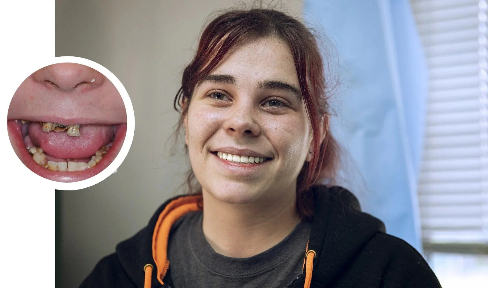A woman smiling with messy and decayed teeth, showing poor dental health.